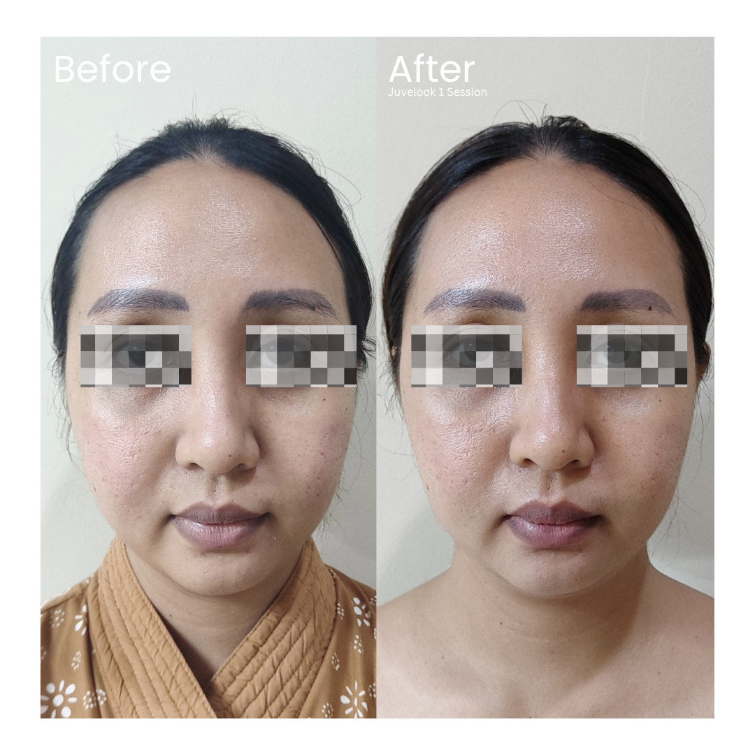 Before and after result 5 for Skin Treatment treatment at Healthy Look Aesthetic