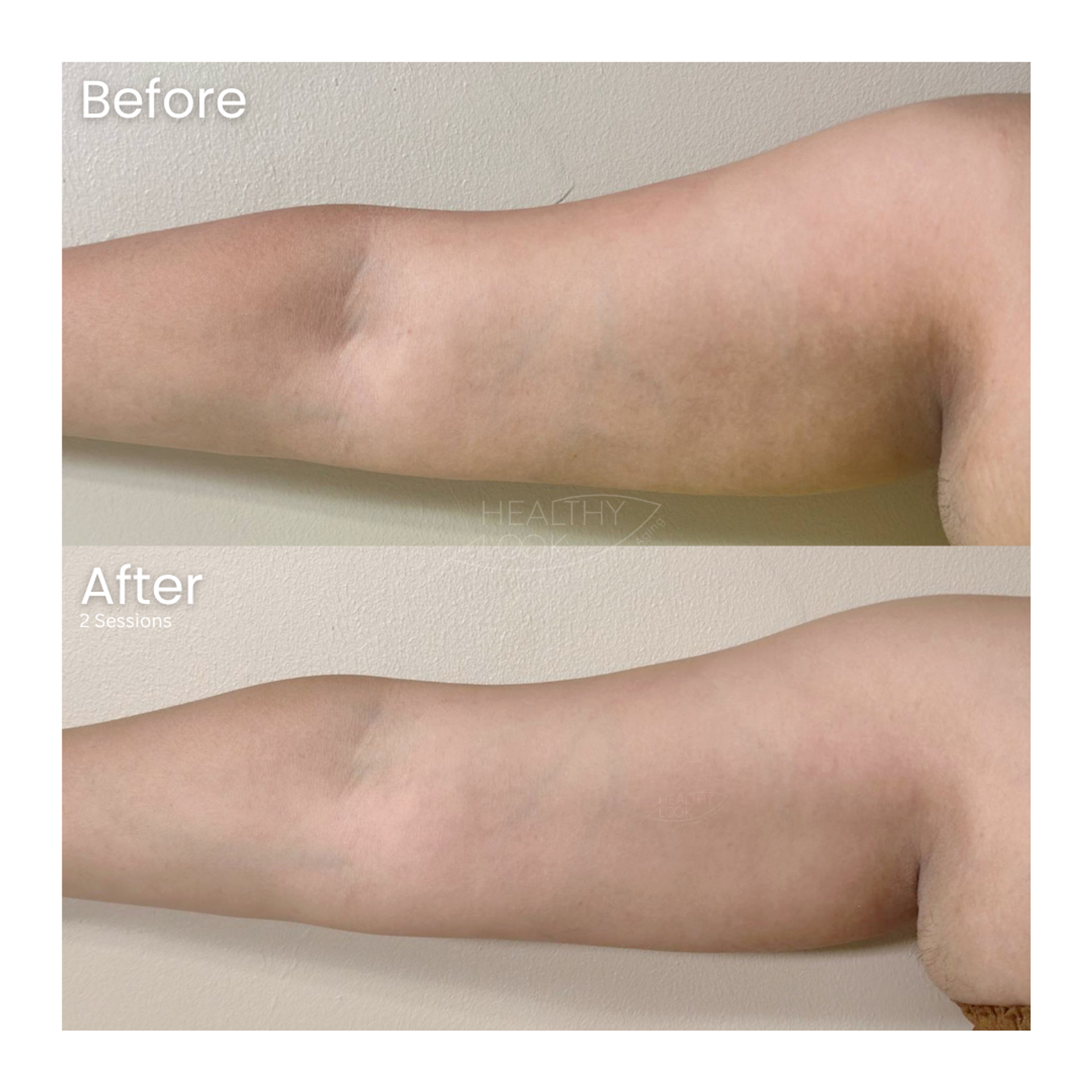 Before and after result 6 for Lysiwave treatment at Healthy Look Aesthetic