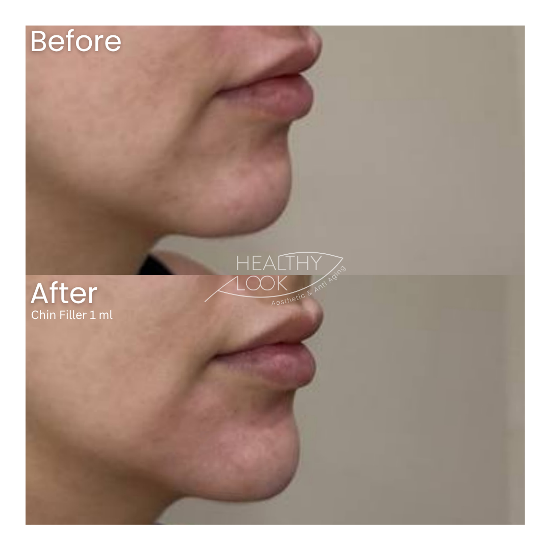 Before and after result 19 for Dermal Filler treatment at Healthy Look Aesthetic