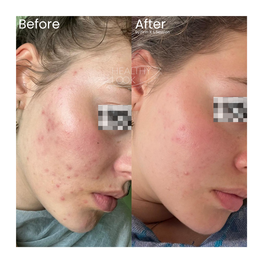 Before and after result 1 for Skin Treatment treatment at Healthy Look Aesthetic
