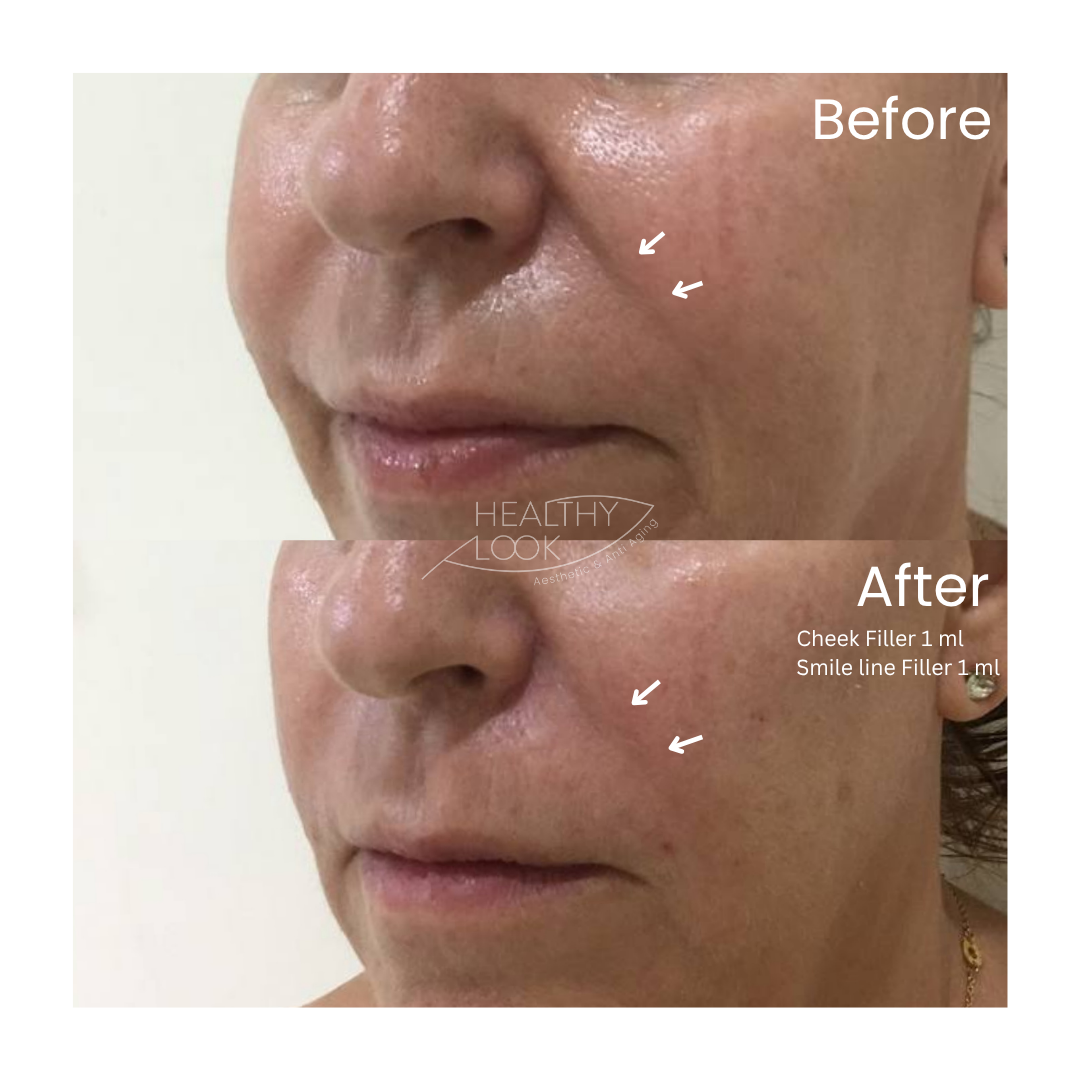 Before and after result 4 for Dermal Filler treatment at Healthy Look Aesthetic