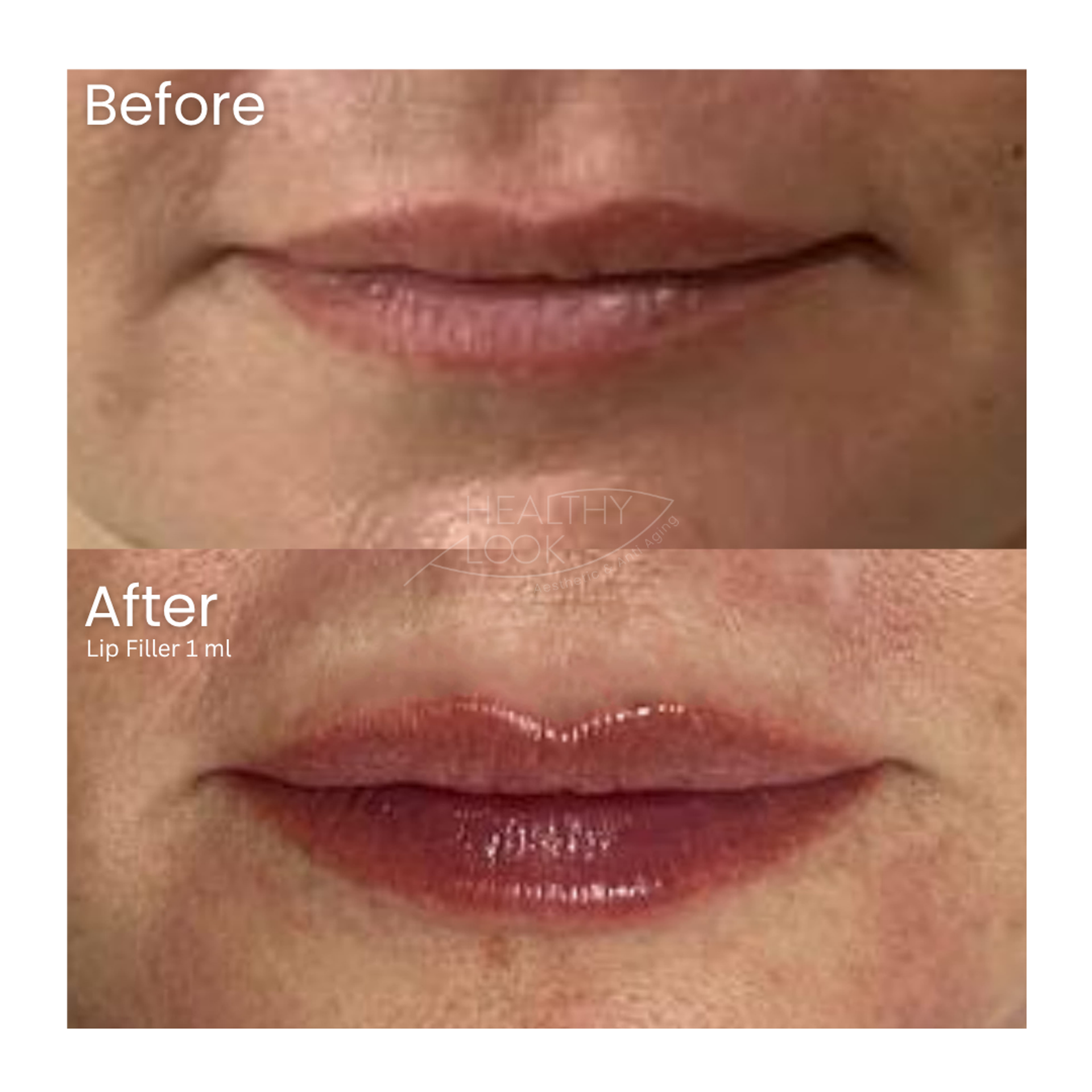 Before and after result 6 for Lip Filler treatment at Healthy Look Aesthetic