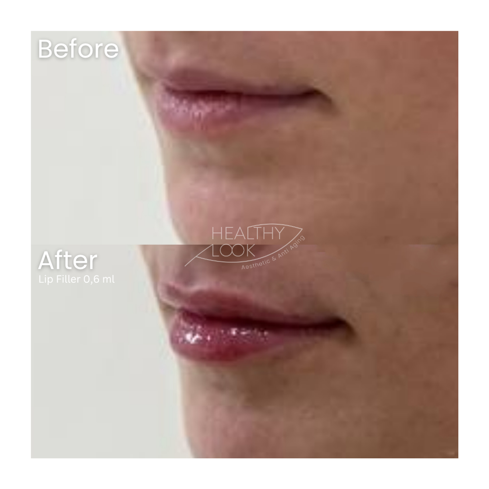 Before and after result 5 for Lip Filler treatment at Healthy Look Aesthetic