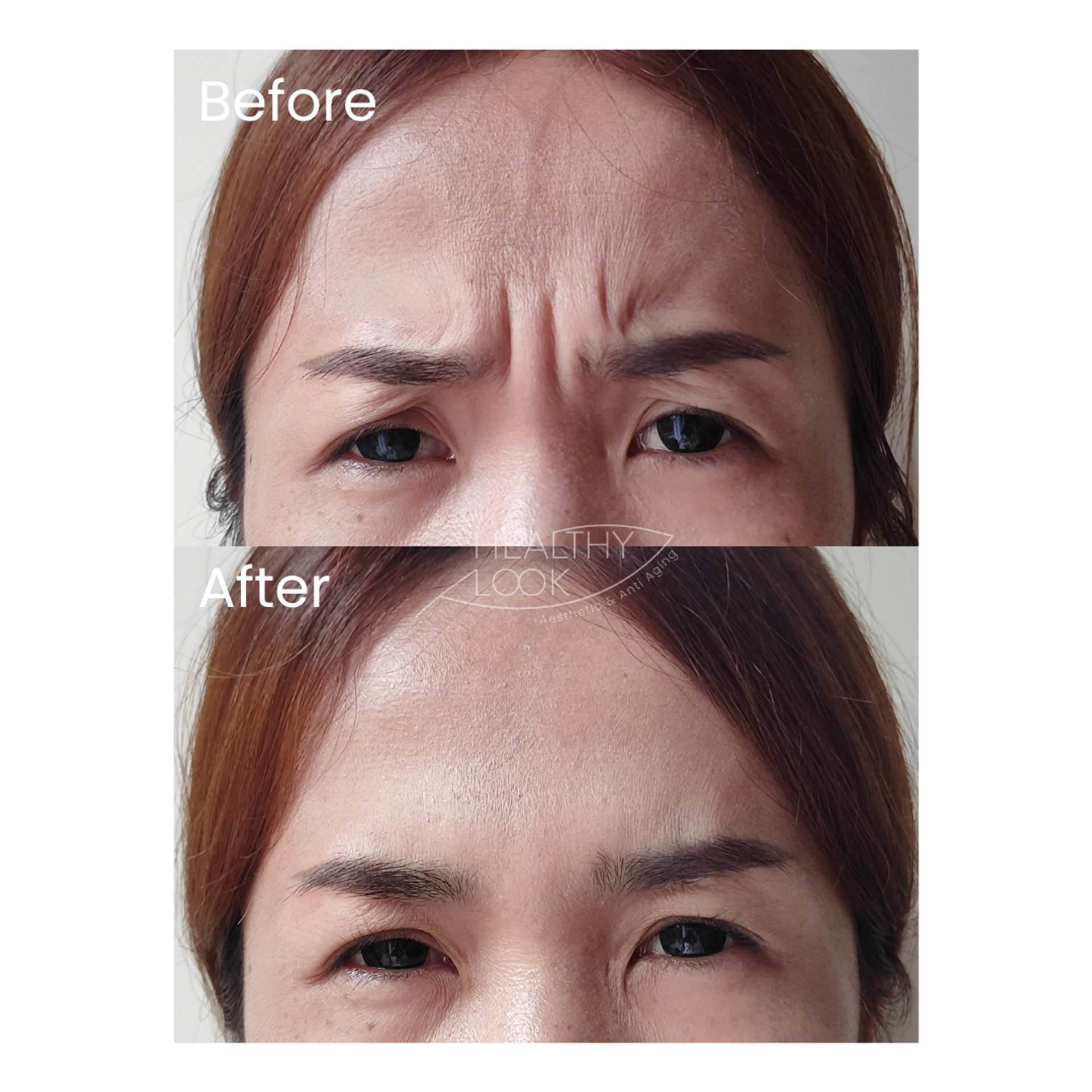 Before and after result 11 for Botox treatment at Healthy Look Aesthetic