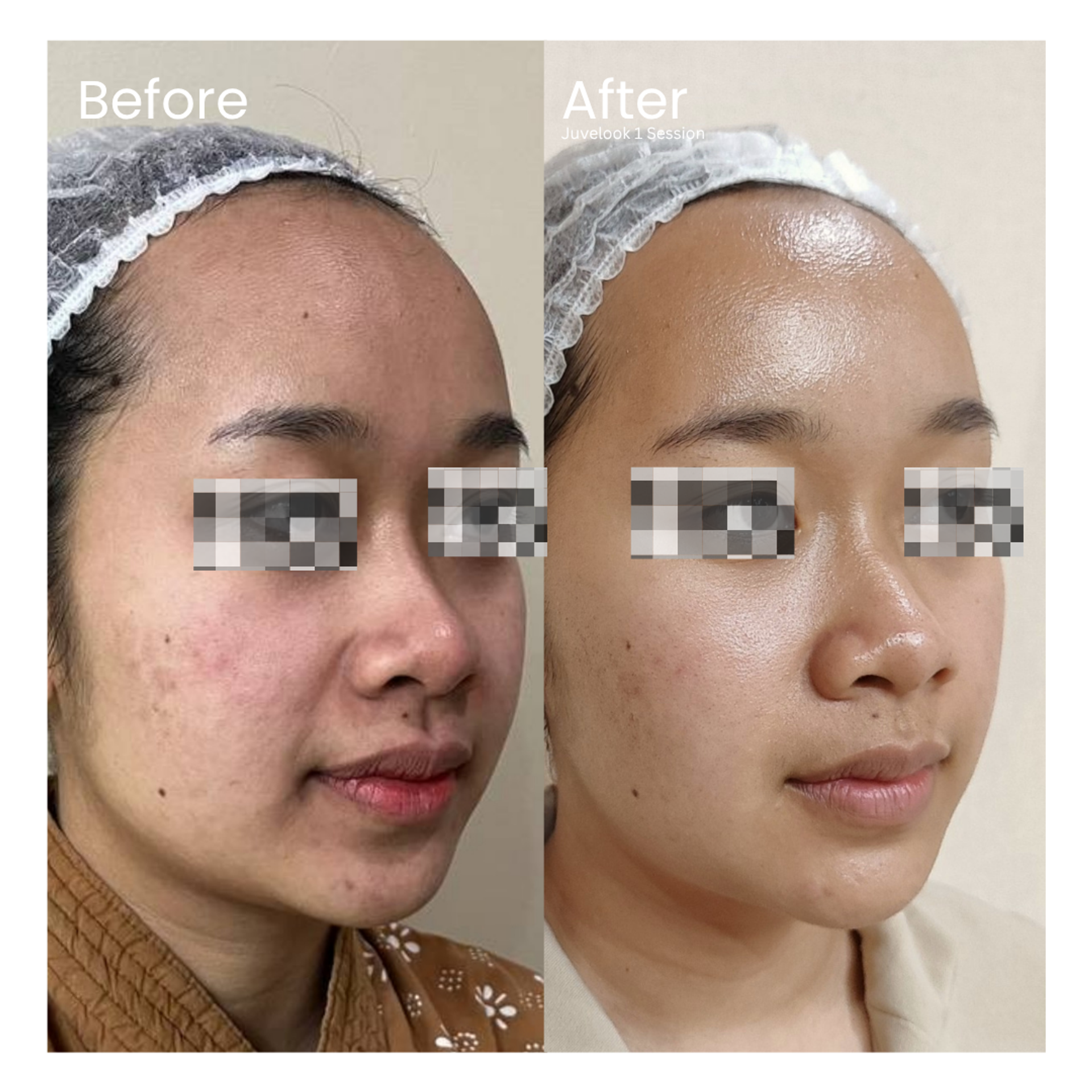 Before and after result 8 for Skin Treatment treatment at Healthy Look Aesthetic