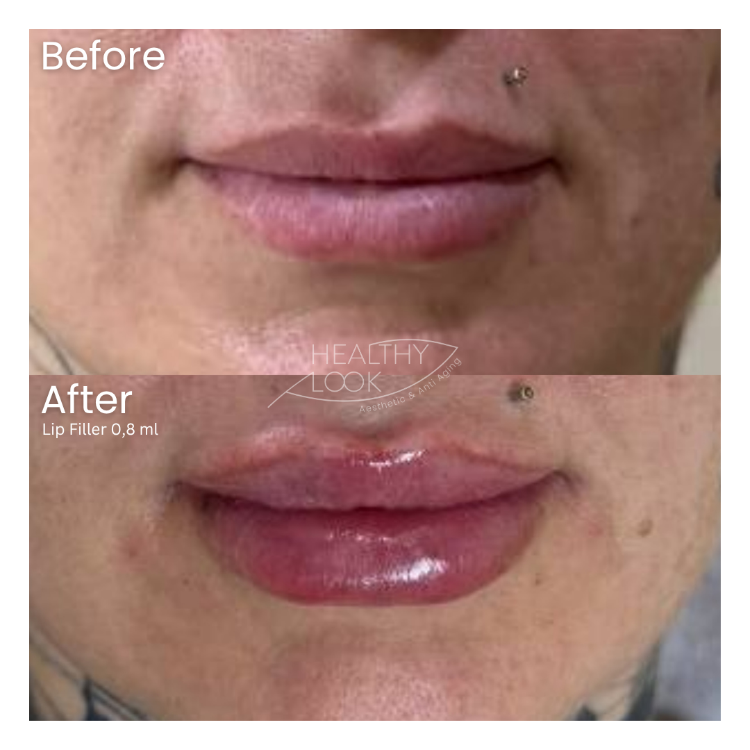 Before and after result 34 for Lip Filler treatment at Healthy Look Aesthetic
