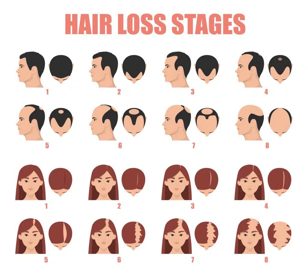 Hair loss stages in men and women