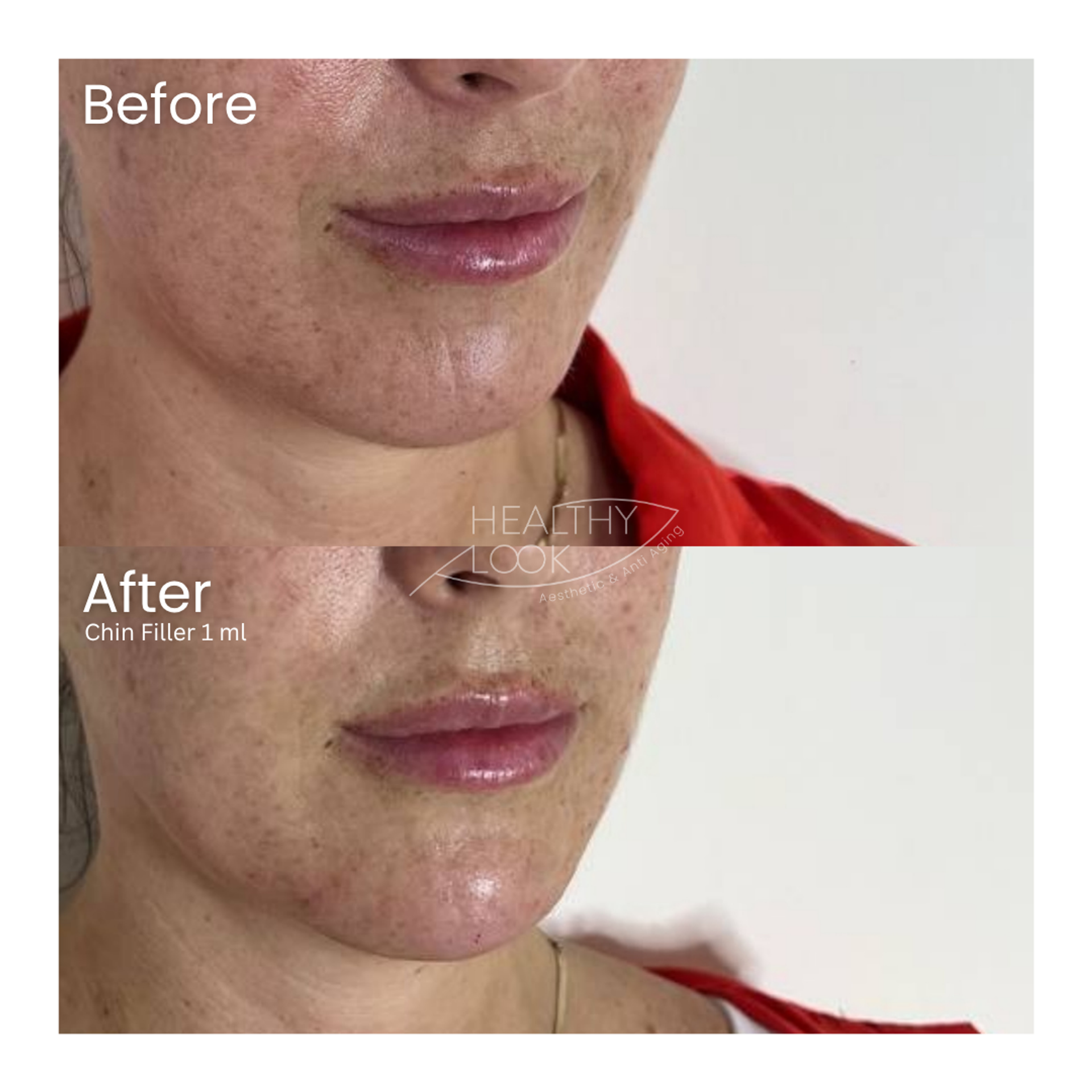 Before and after result 9 for Dermal Filler treatment at Healthy Look Aesthetic