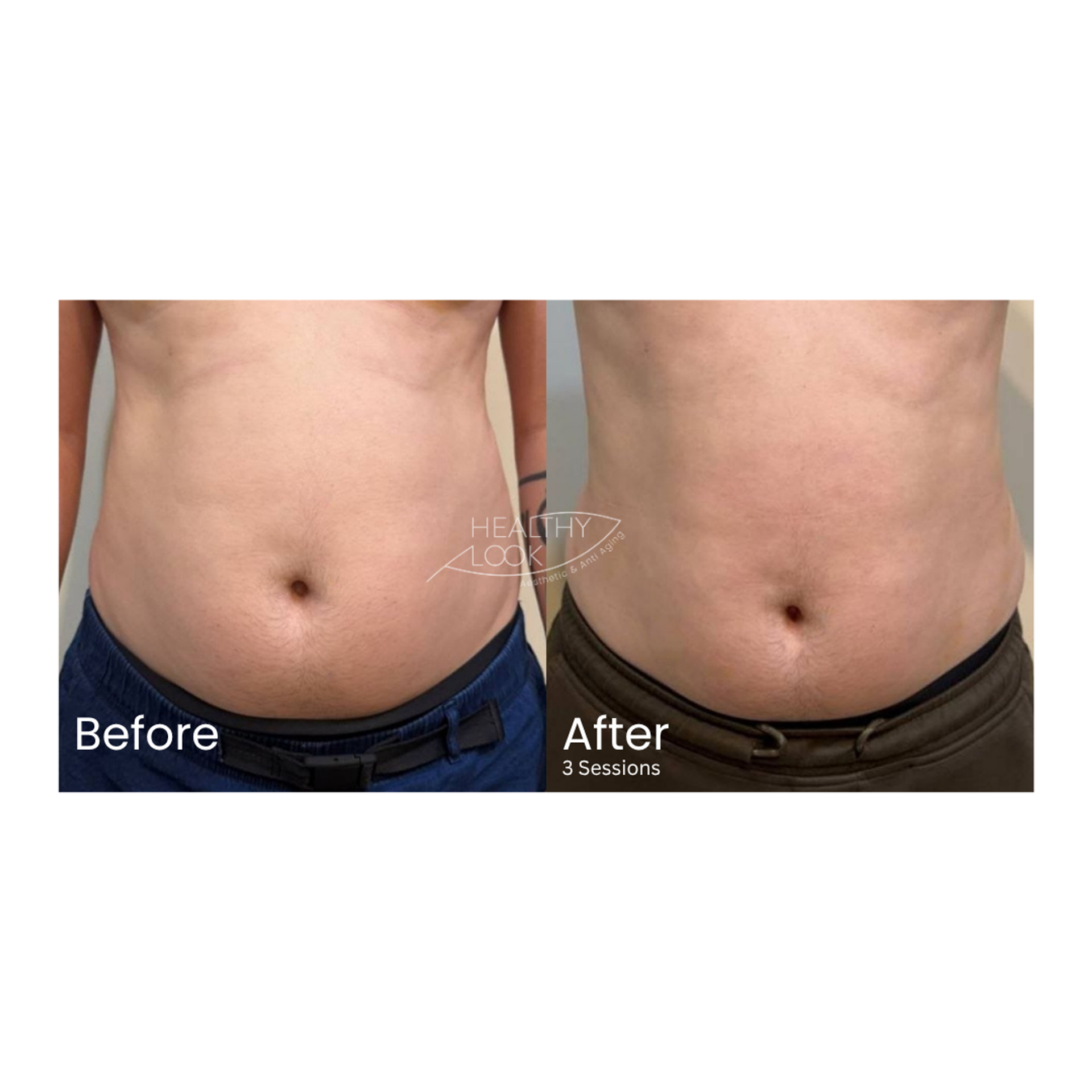 CE Certified Muscle Sculpting by CM Slim before and after result