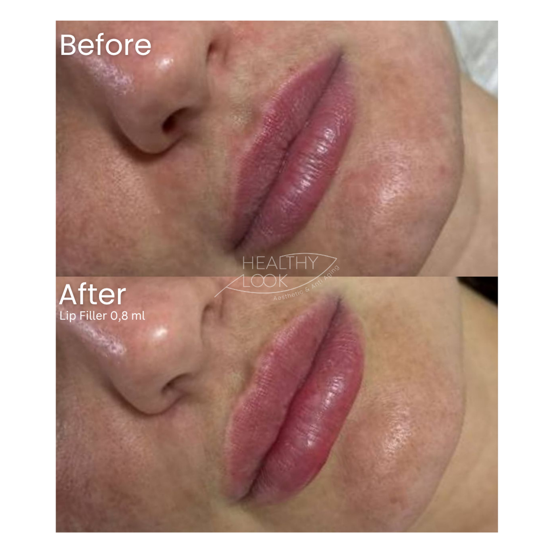 Before and after result 18 for Lip Filler treatment at Healthy Look Aesthetic