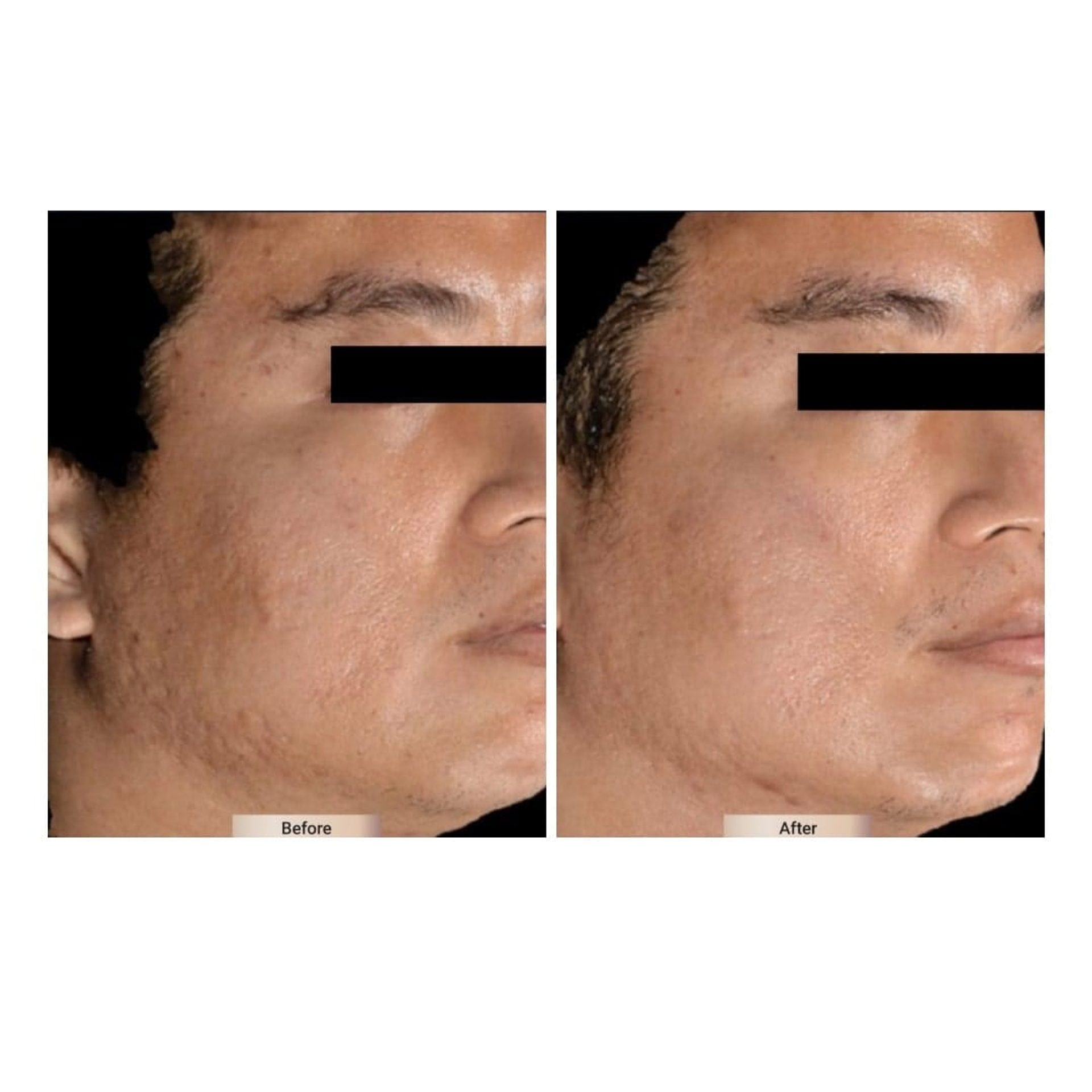 Before and after result 5 for Sylfirm X treatment at Healthy Look Aesthetic
