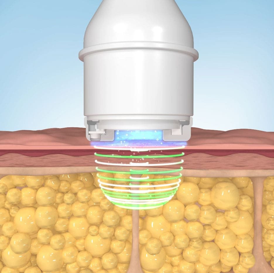 Lysiwave handpiece heating the fat layer beneath the skin