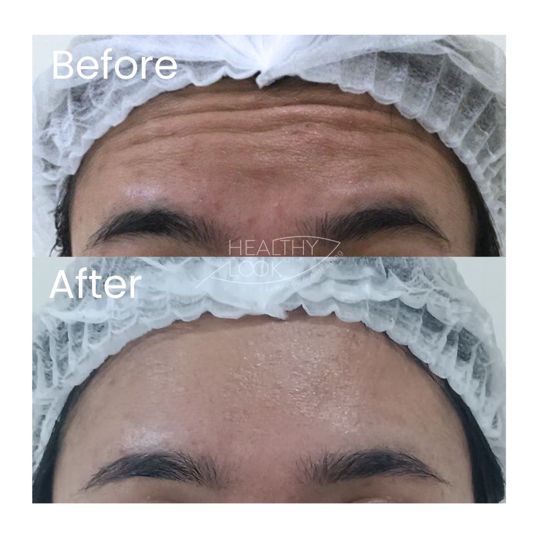 Before and after result 14 for Botox treatment at Healthy Look Aesthetic