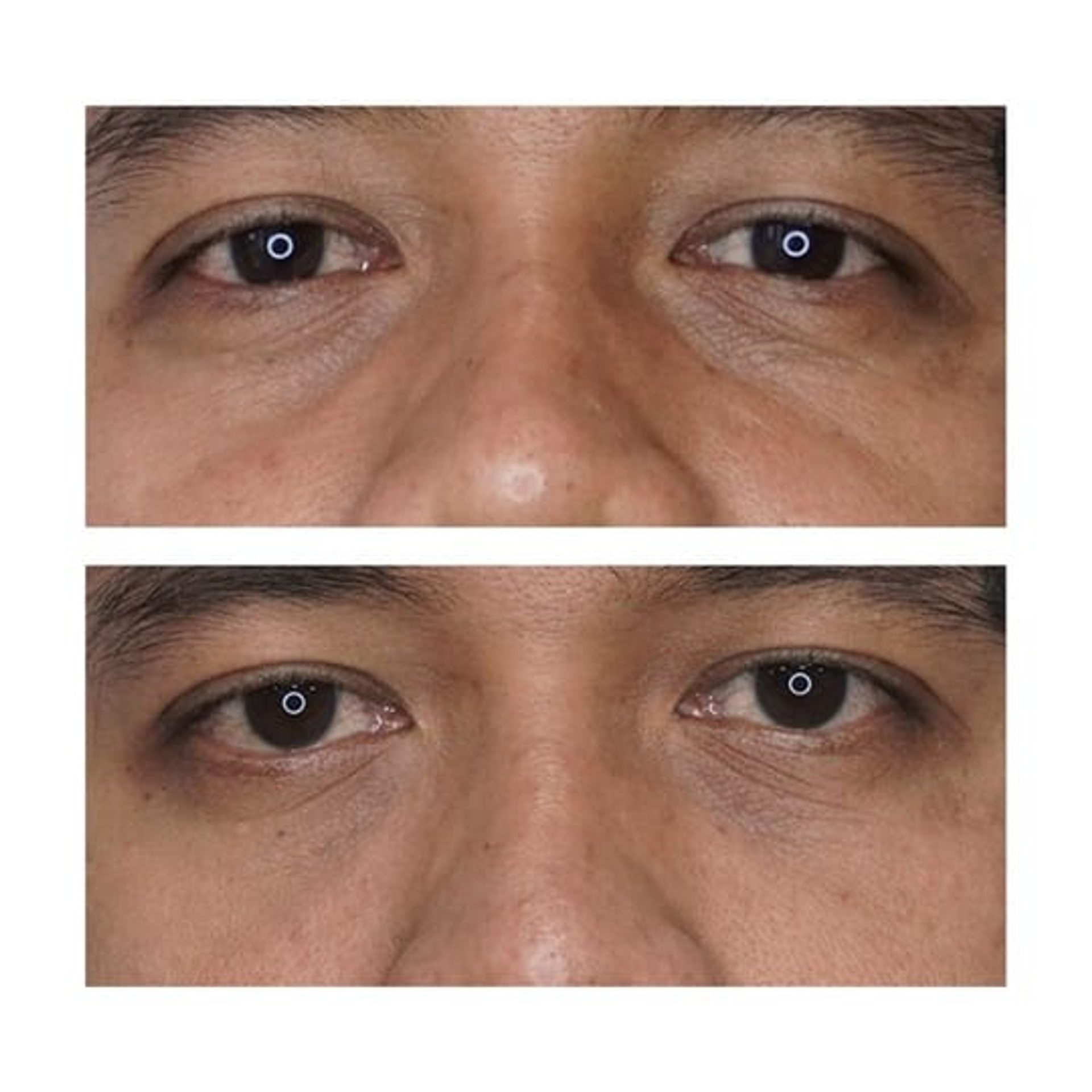 Before and after result 9 for Juvelook treatment at Healthy Look Aesthetic