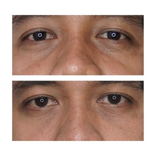 Before and after result 9 for Juvelook treatment at Healthy Look Aesthetic