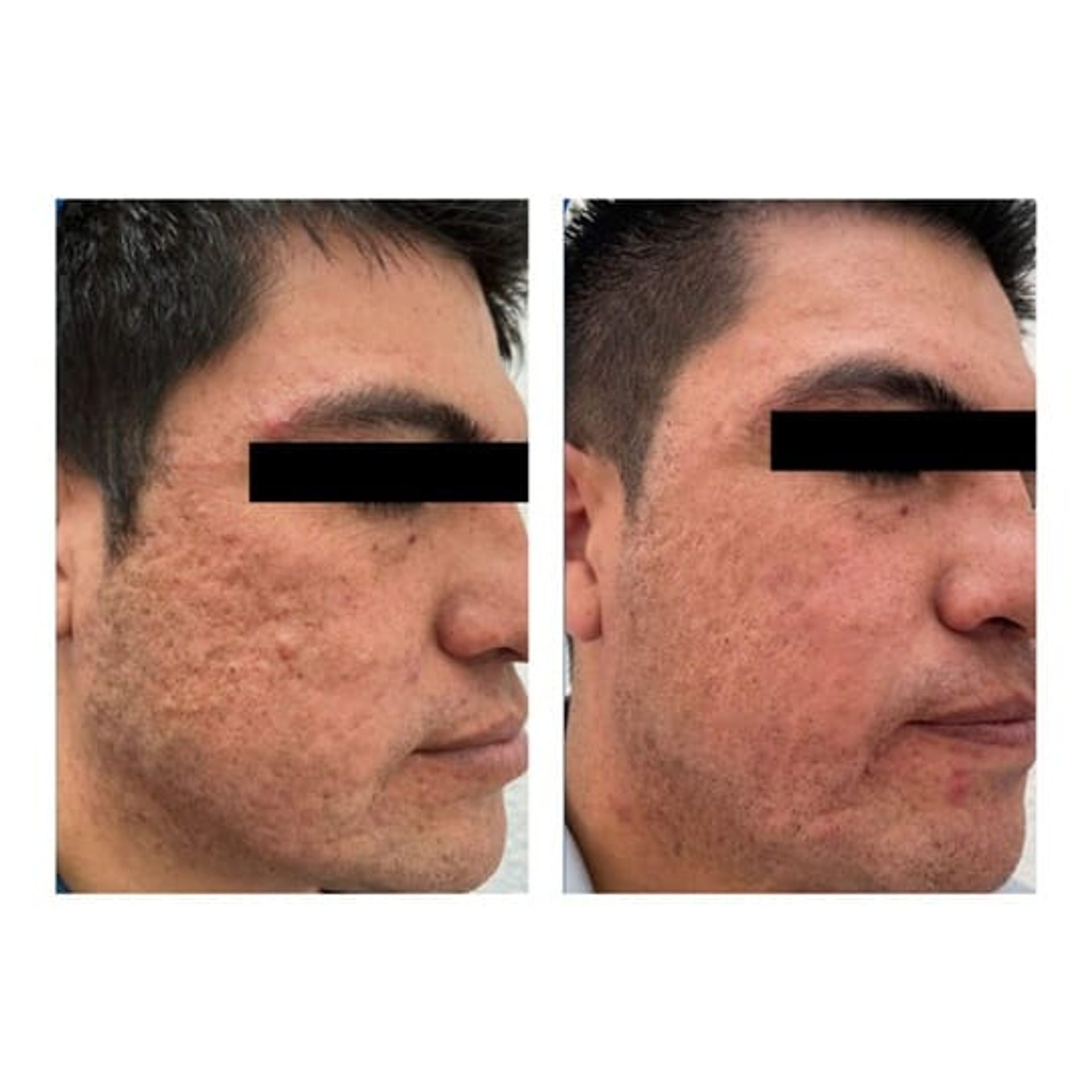 Before and after result 7 for Juvelook treatment at Healthy Look Aesthetic