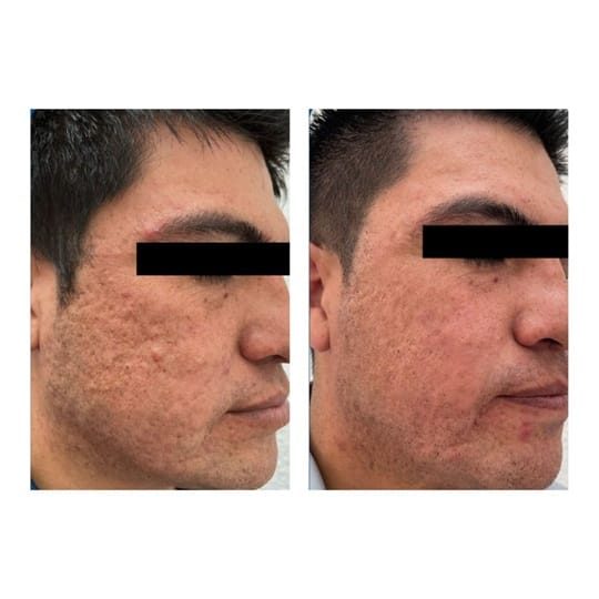 Before and after result 7 for Juvelook treatment at Healthy Look Aesthetic