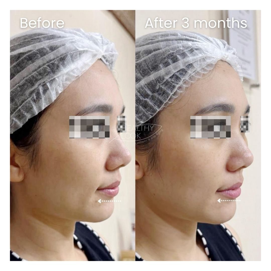 Before and after XERF Treatment at Healthy Look Aesthetic, Ubud