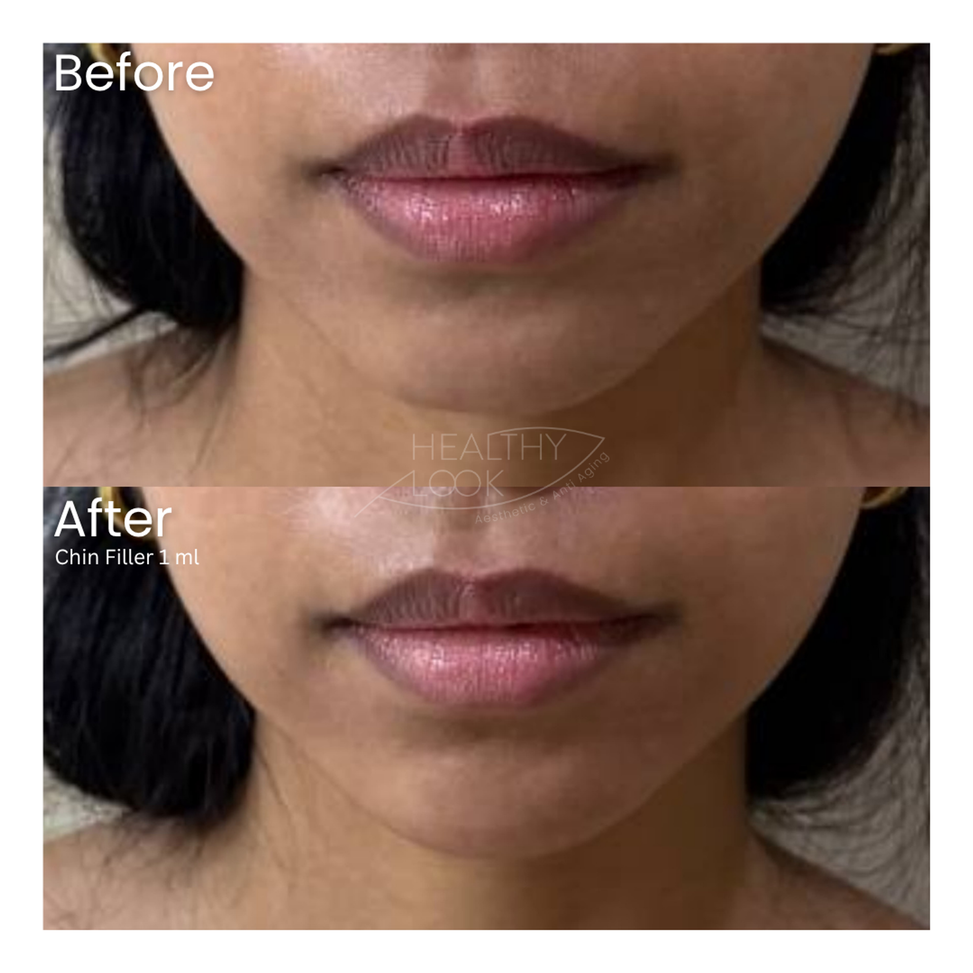 Before and after result 15 for Dermal Filler treatment at Healthy Look Aesthetic