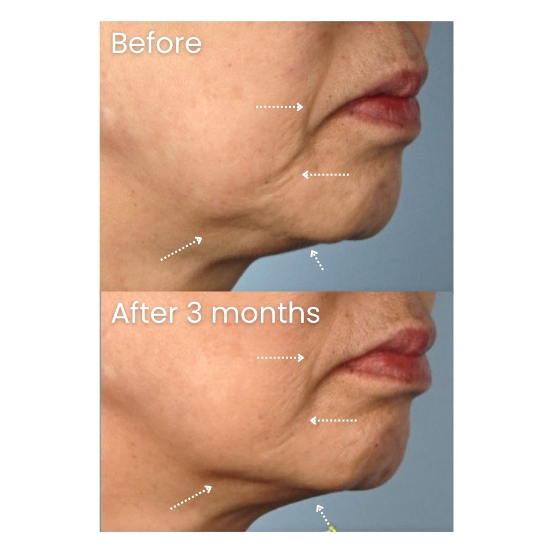 Before and after XERF Treatment at Healthy Look Aesthetic, Ubud