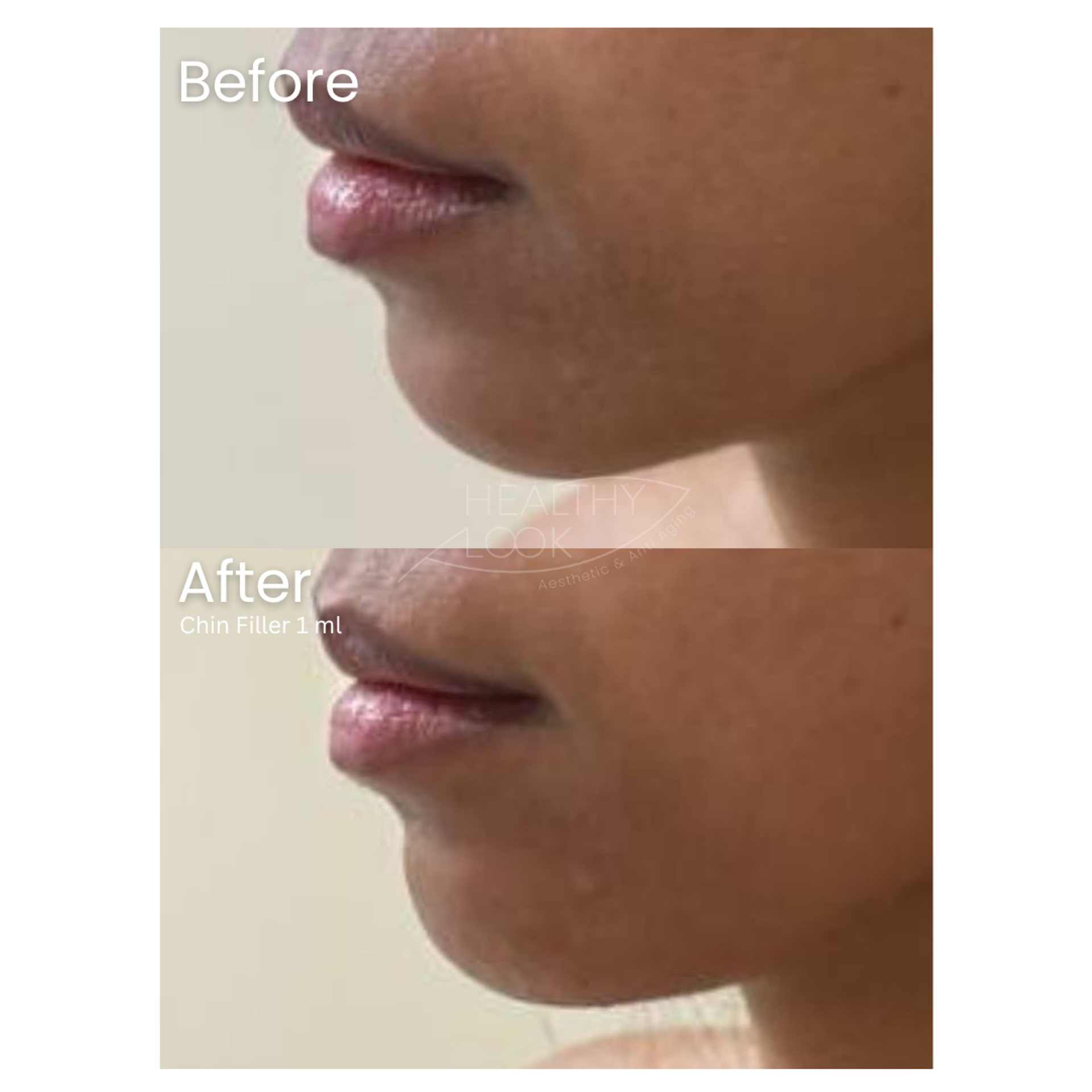 Before and after result 16 for Dermal Filler treatment at Healthy Look Aesthetic