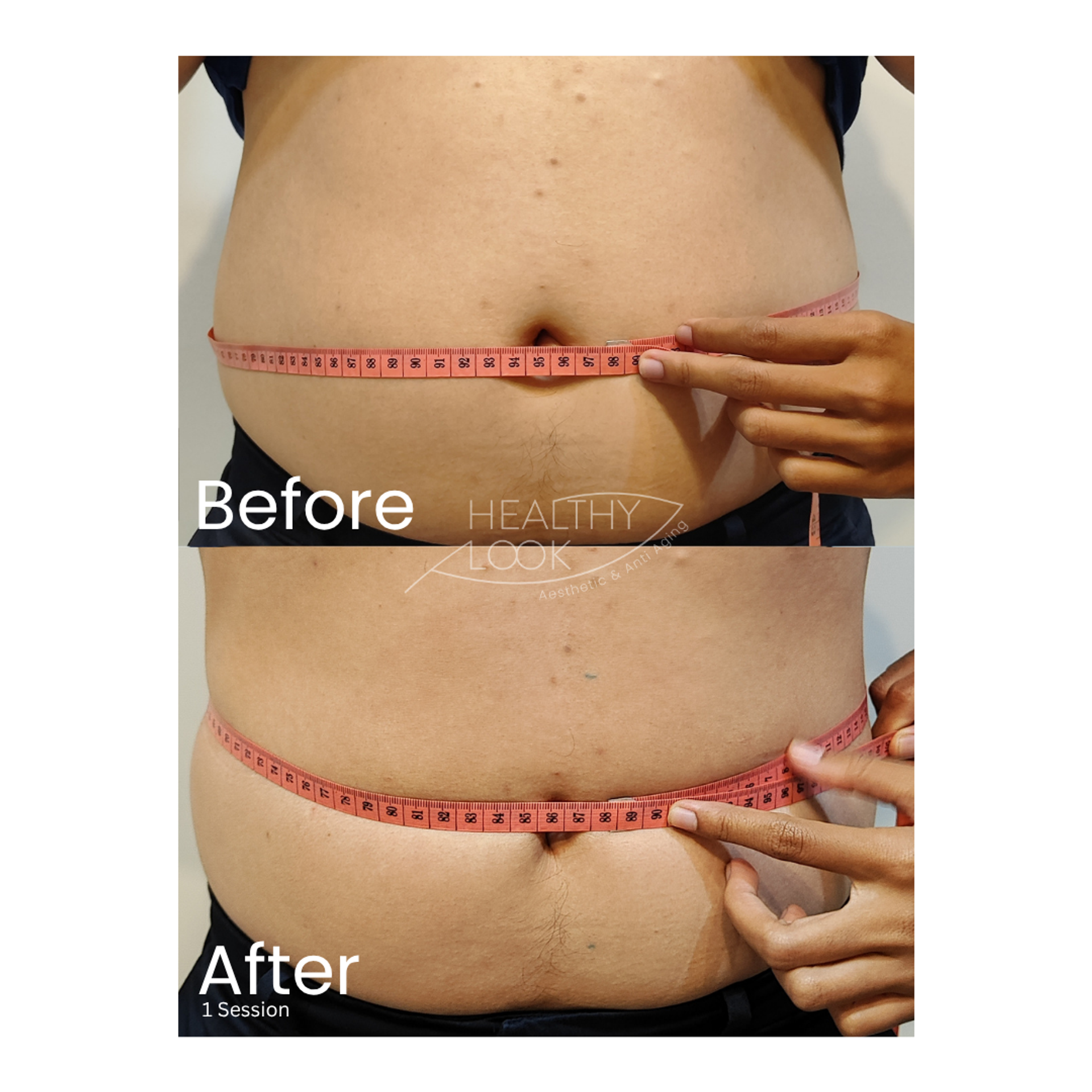 Before and after result 7 for CE Certified Muscle Sculpting by CM Slim treatment at Healthy Look Aesthetic