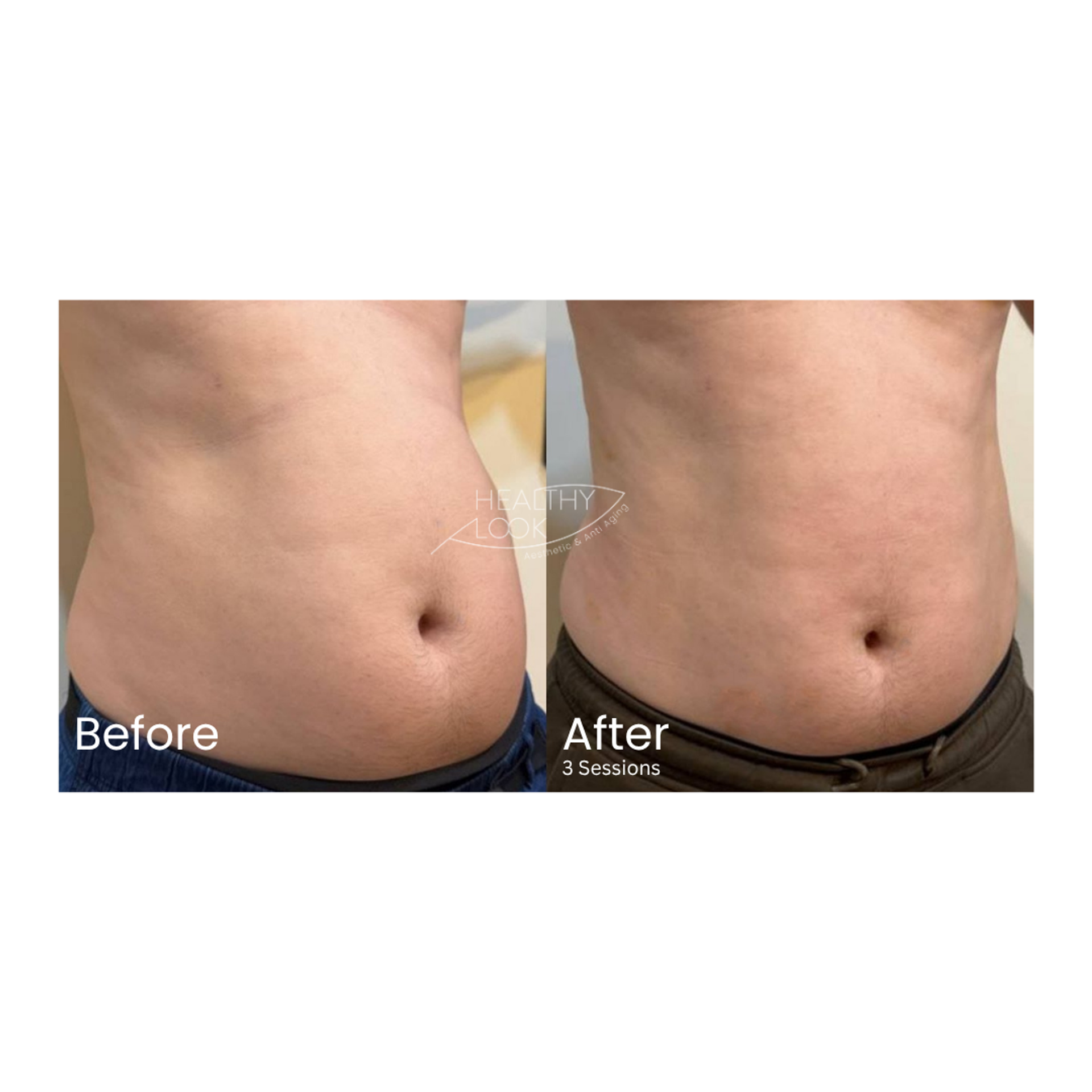 Before and after result 2 for CE Certified Muscle Sculpting by CM Slim treatment at Healthy Look Aesthetic