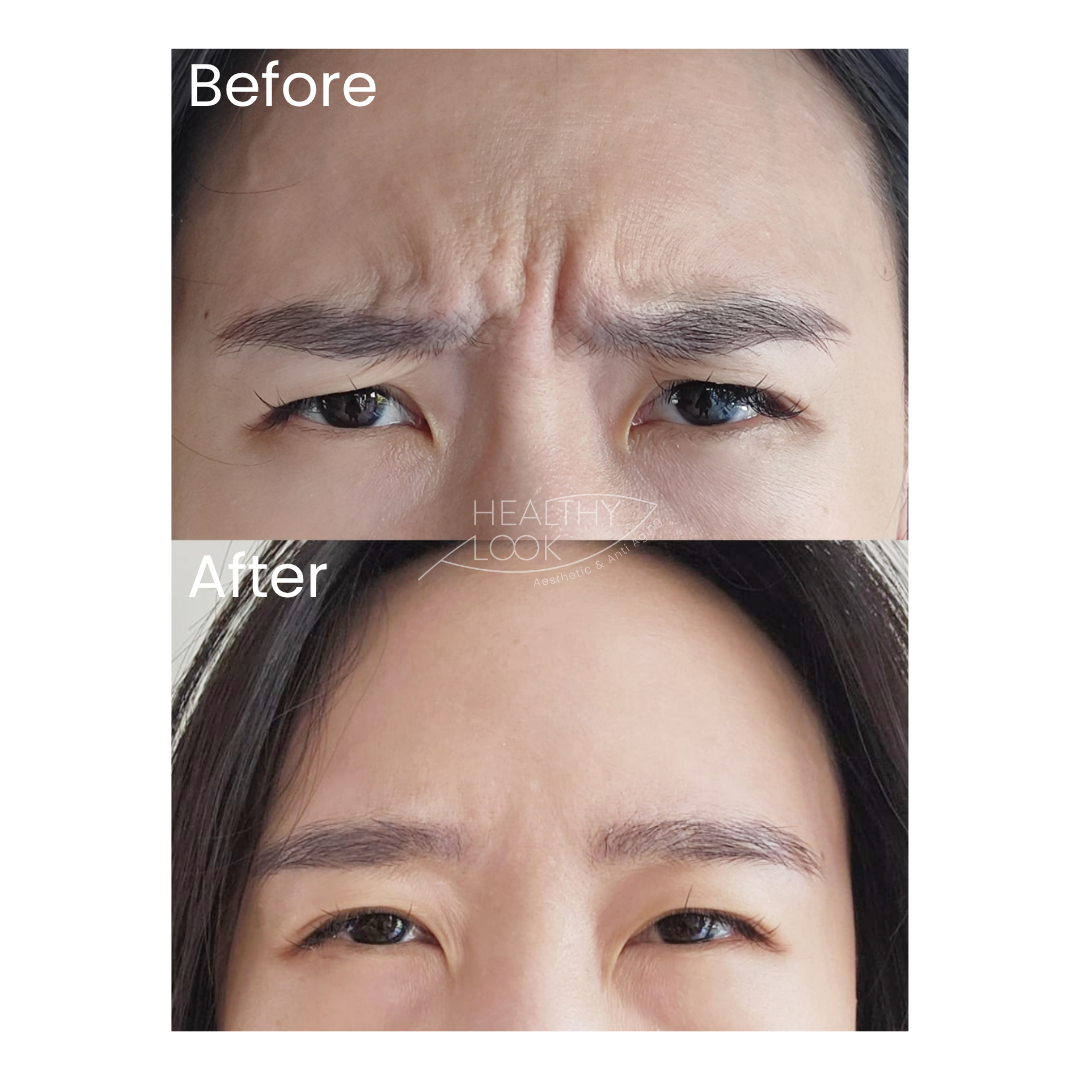 Before and after result 4 for Botox treatment at Healthy Look Aesthetic