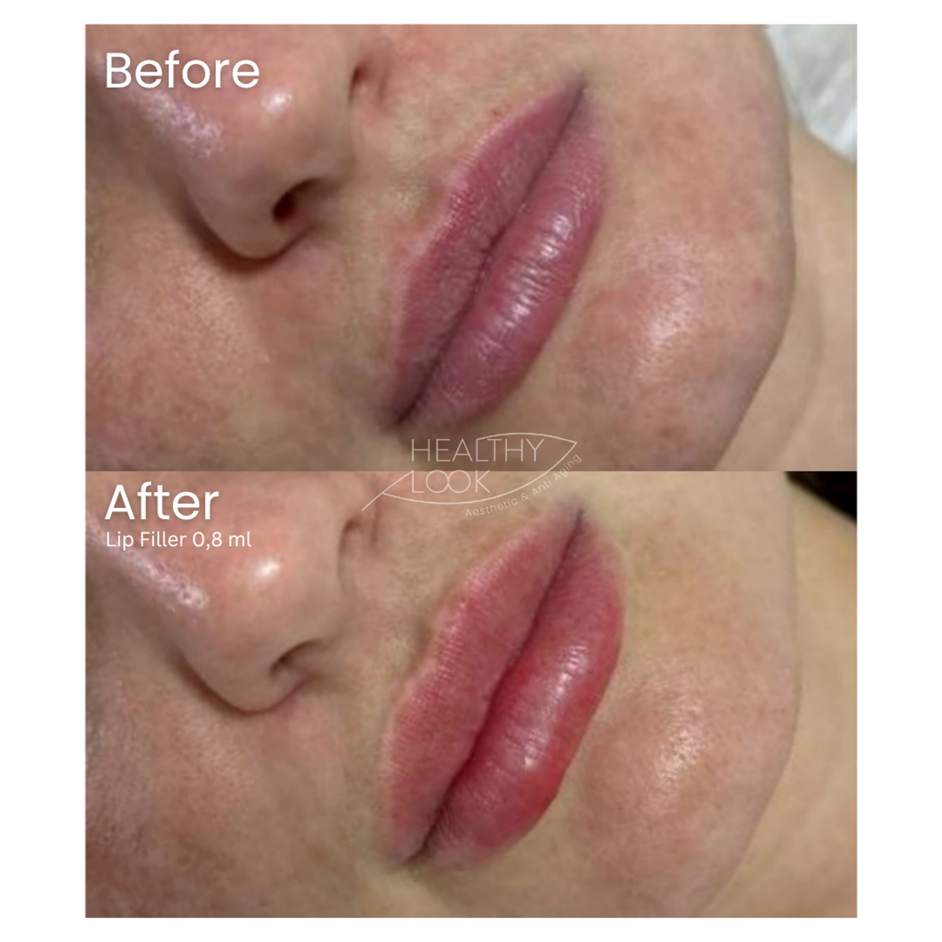 Before and after result 29 for Lip Filler treatment at Healthy Look Aesthetic
