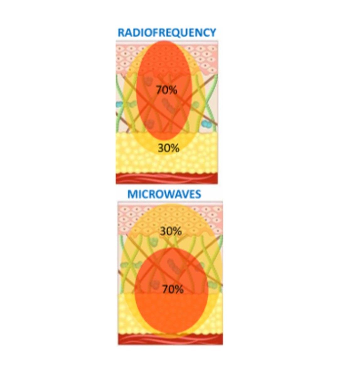 How deep radiofrequency and microwaves heat the skin, compared