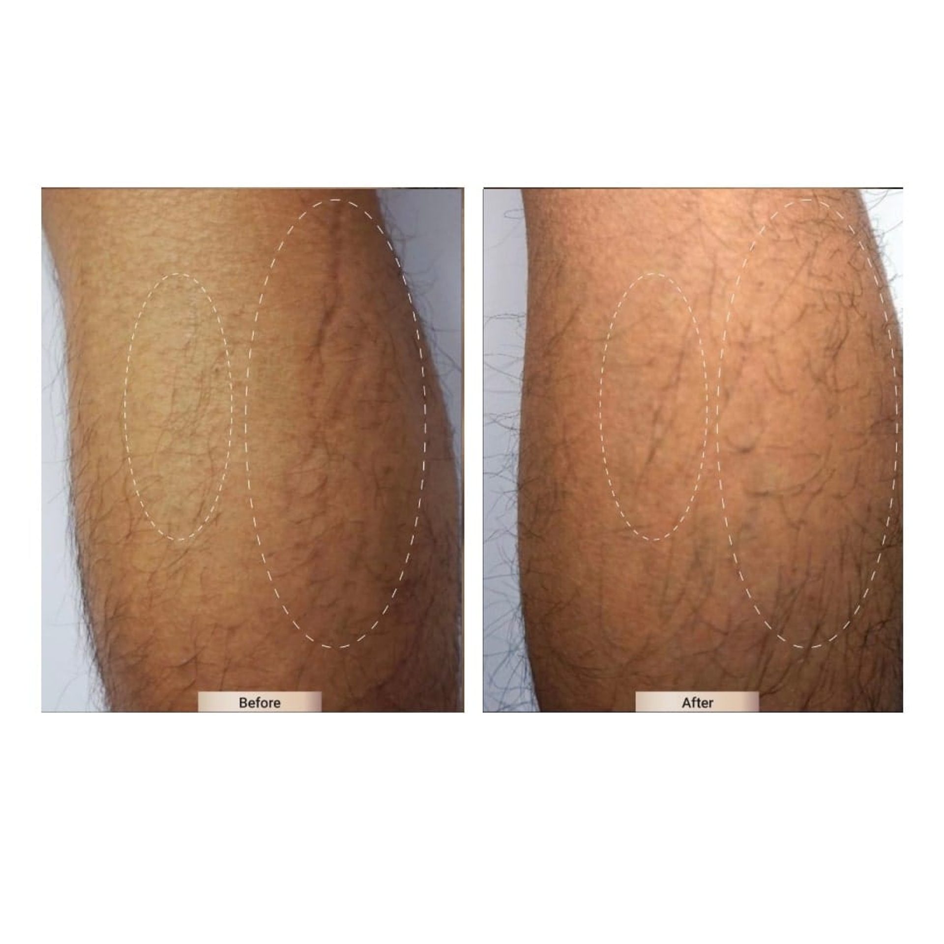 Before and after result 8 for Sylfirm X treatment at Healthy Look Aesthetic