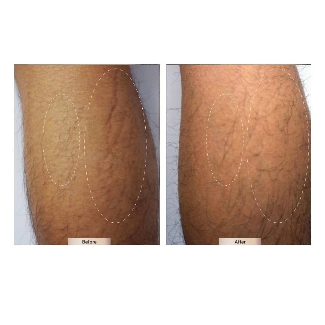 Before and after result 8 for Sylfirm X treatment at Healthy Look Aesthetic