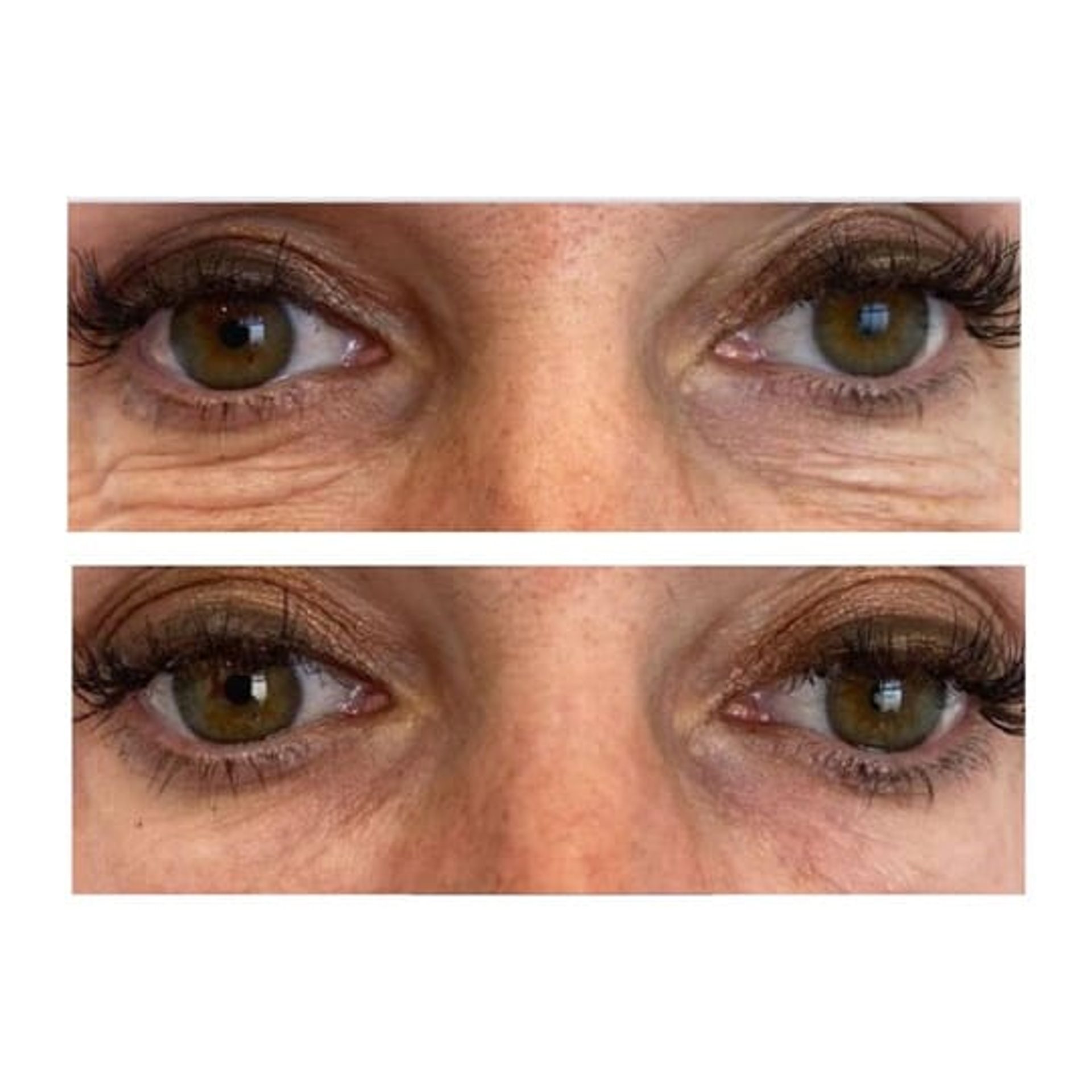 Before and after result 8 for Juvelook treatment at Healthy Look Aesthetic