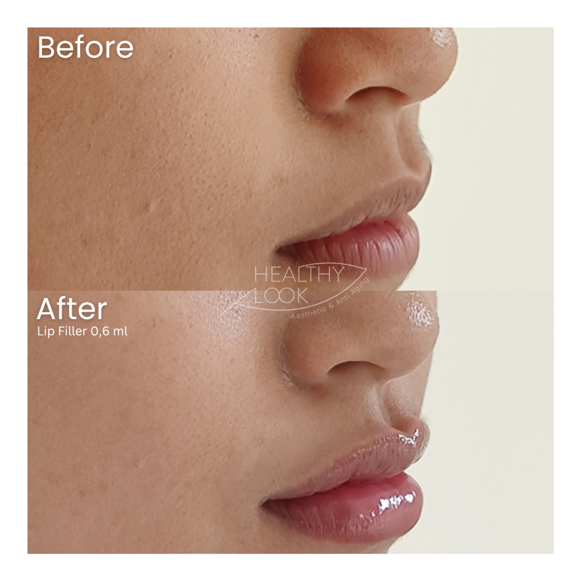 Before and after result 11 for Lip Filler treatment at Healthy Look Aesthetic