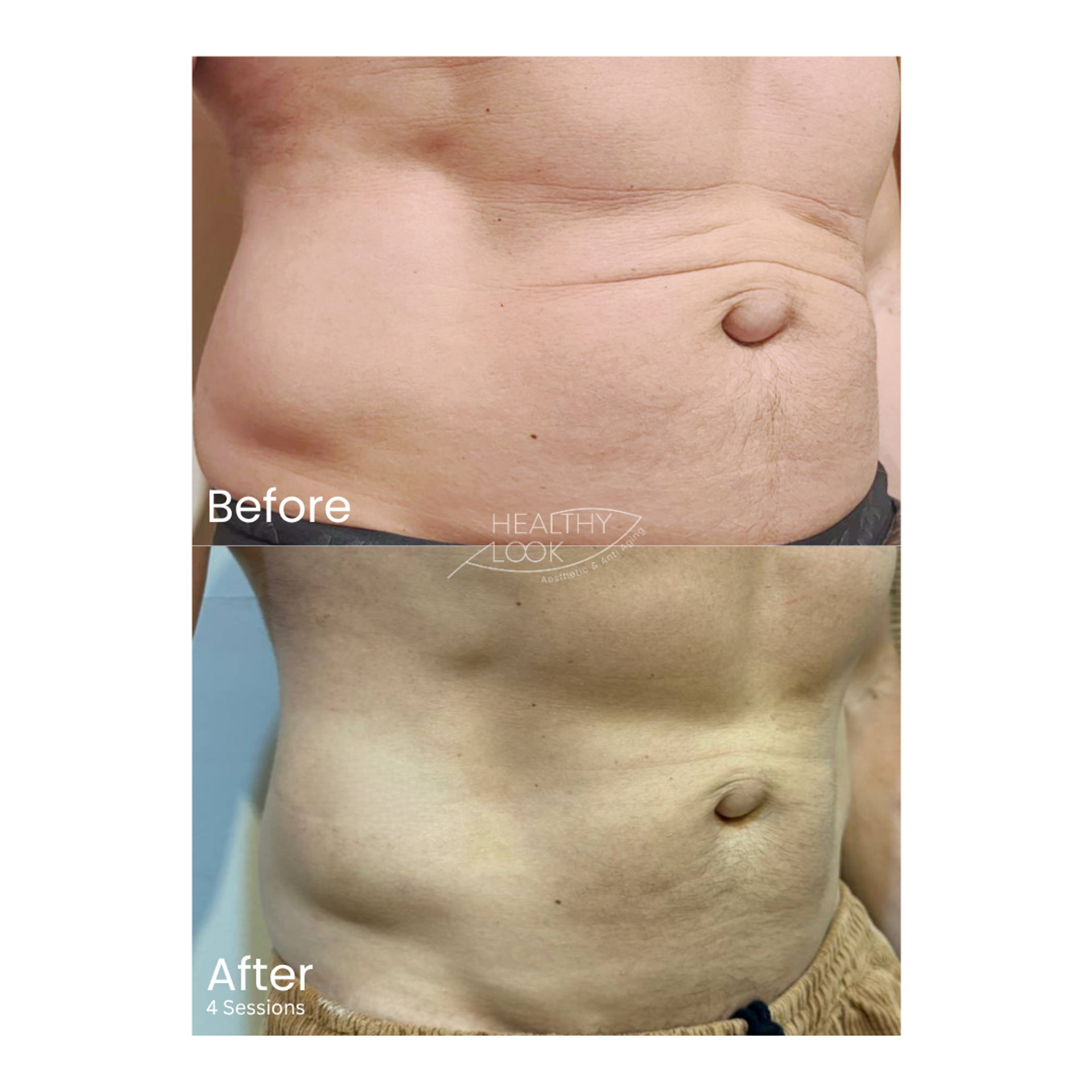 Before and after result 4 for CE Certified Muscle Sculpting by CM Slim treatment at Healthy Look Aesthetic