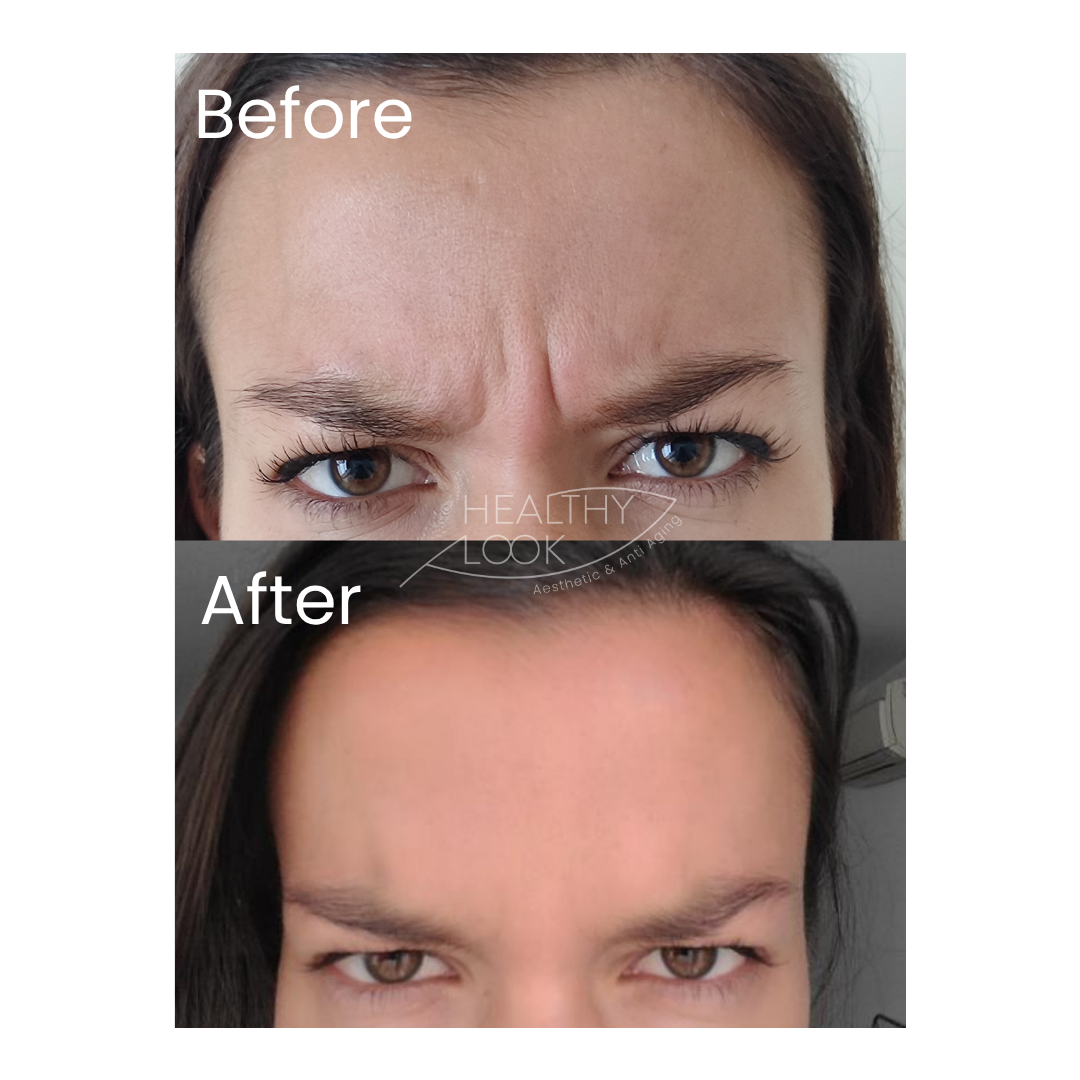Before and after result 2 for Botox treatment at Healthy Look Aesthetic