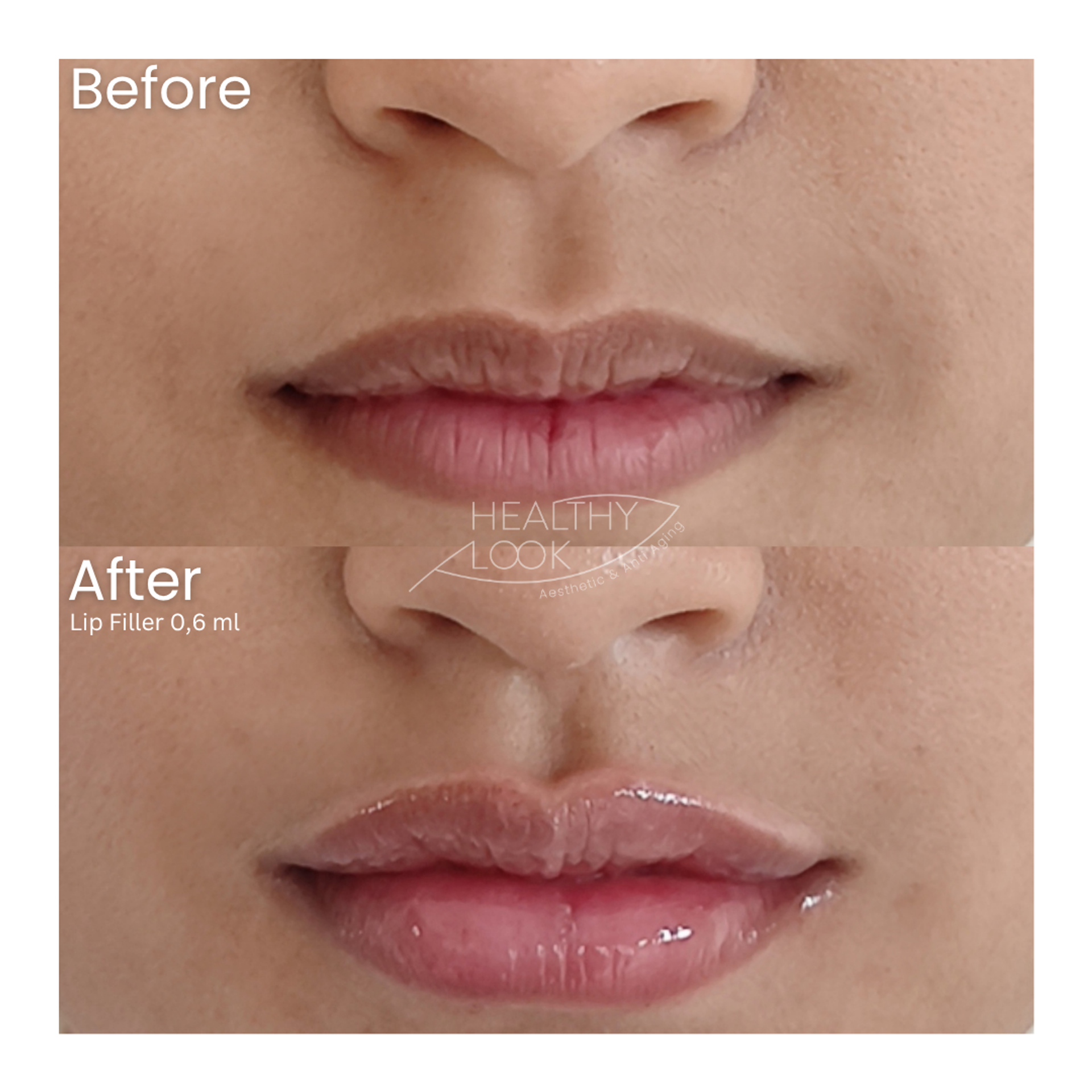 Before and after result 10 for Lip Filler treatment at Healthy Look Aesthetic