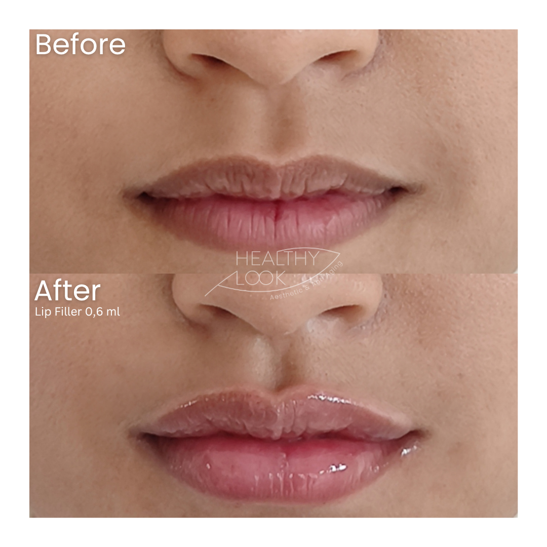 Before and after result 10 for Lip Filler treatment at Healthy Look Aesthetic