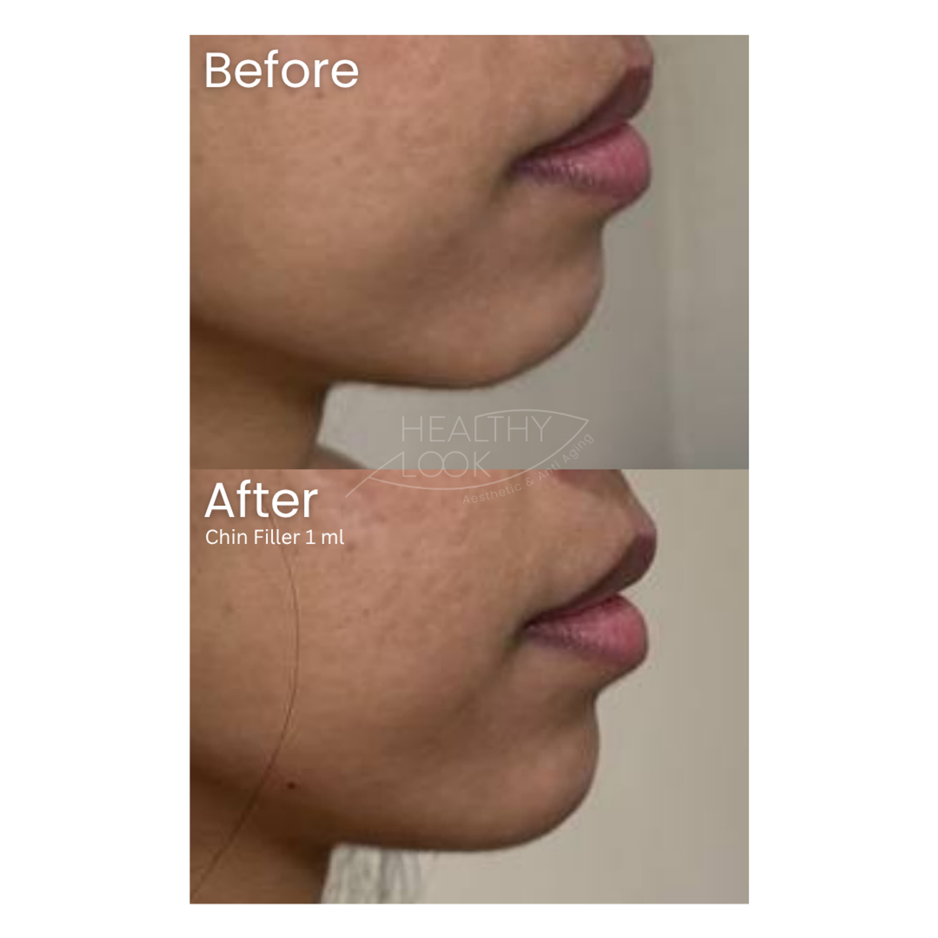 Before and after result 17 for Dermal Filler treatment at Healthy Look Aesthetic