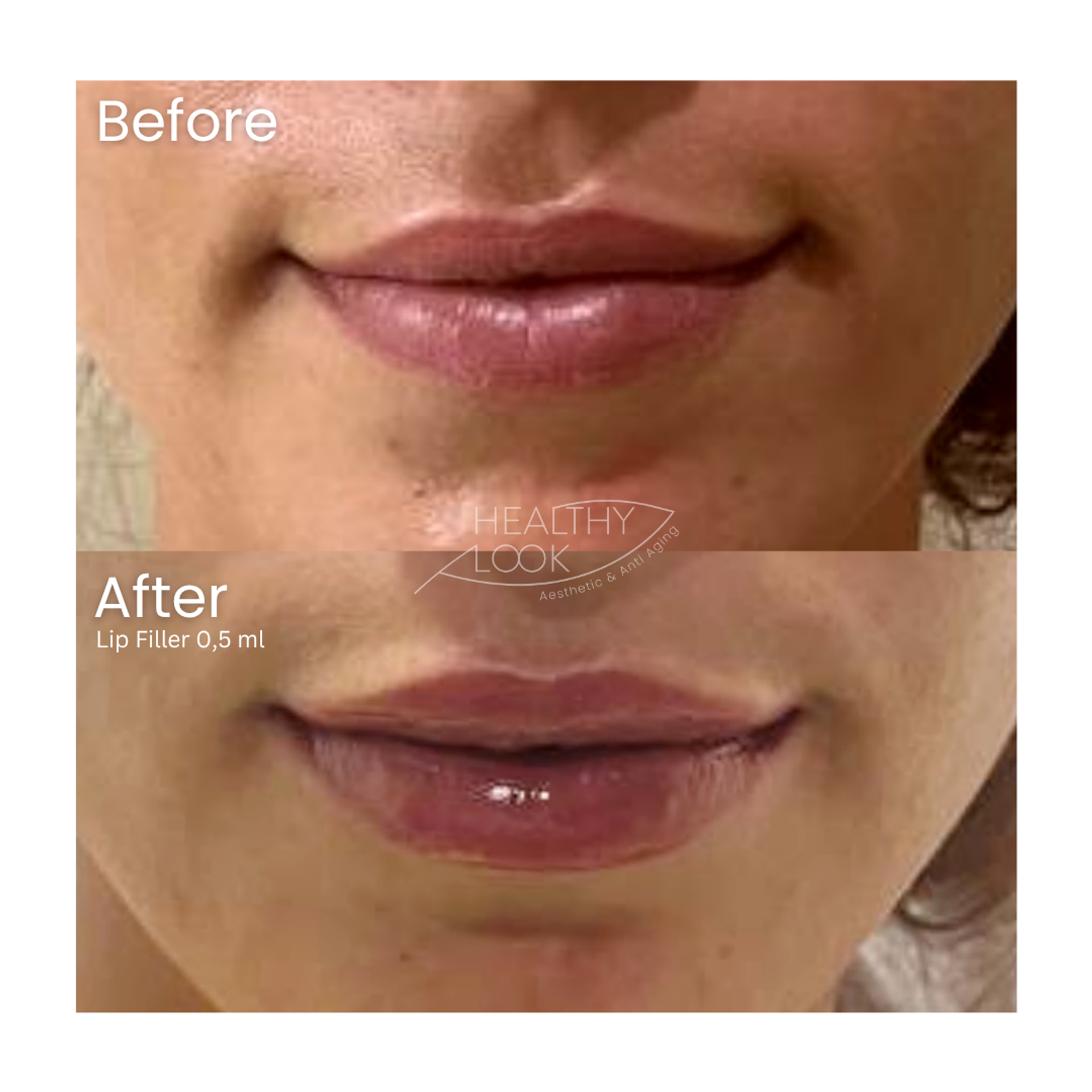 Before and after result 19 for Lip Filler treatment at Healthy Look Aesthetic