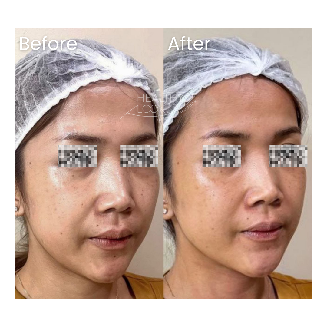 Before and after result 7 for Premium HIFU by Linear Z treatment at Healthy Look Aesthetic