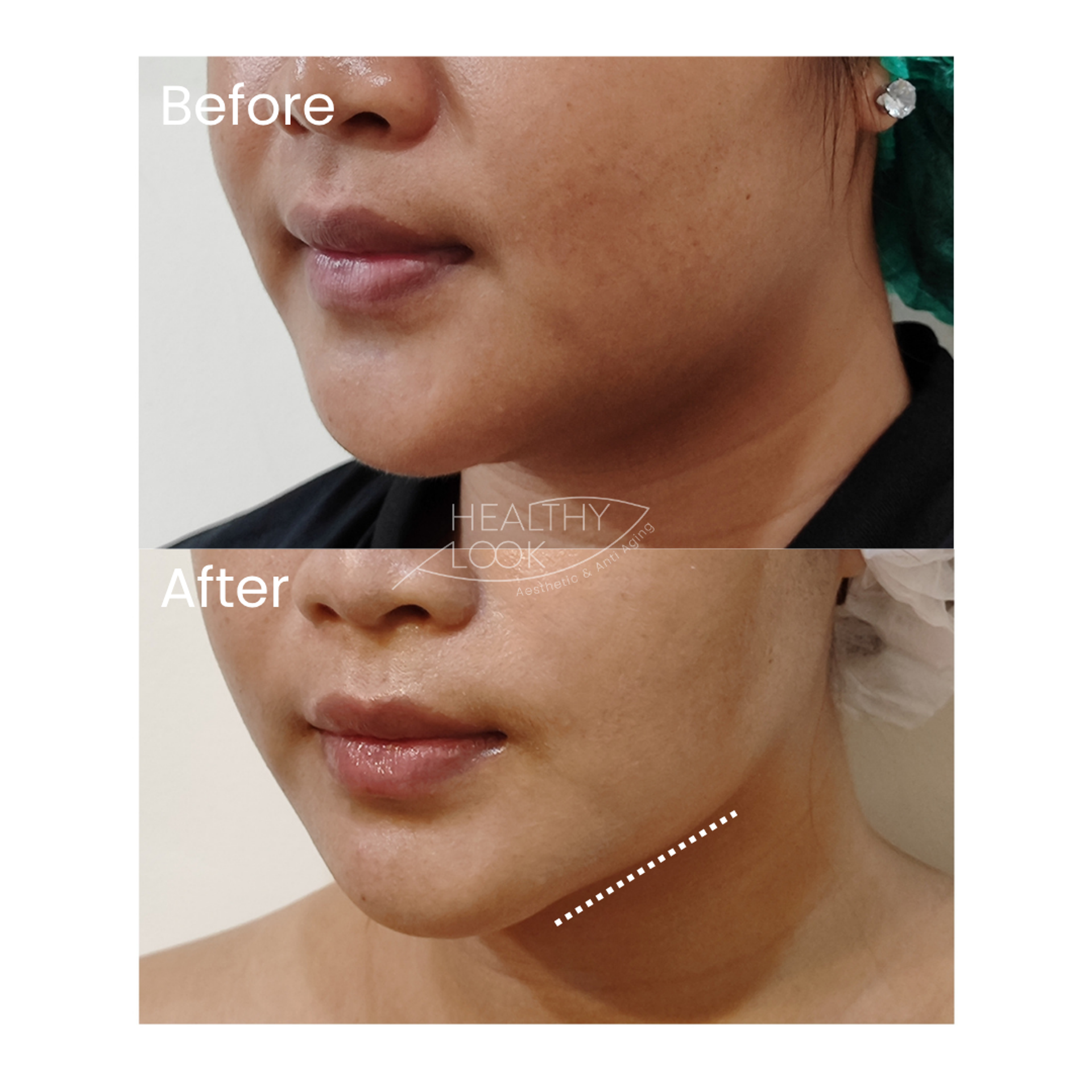 Before and after result 4 for Premium HIFU by Linear Z treatment at Healthy Look Aesthetic