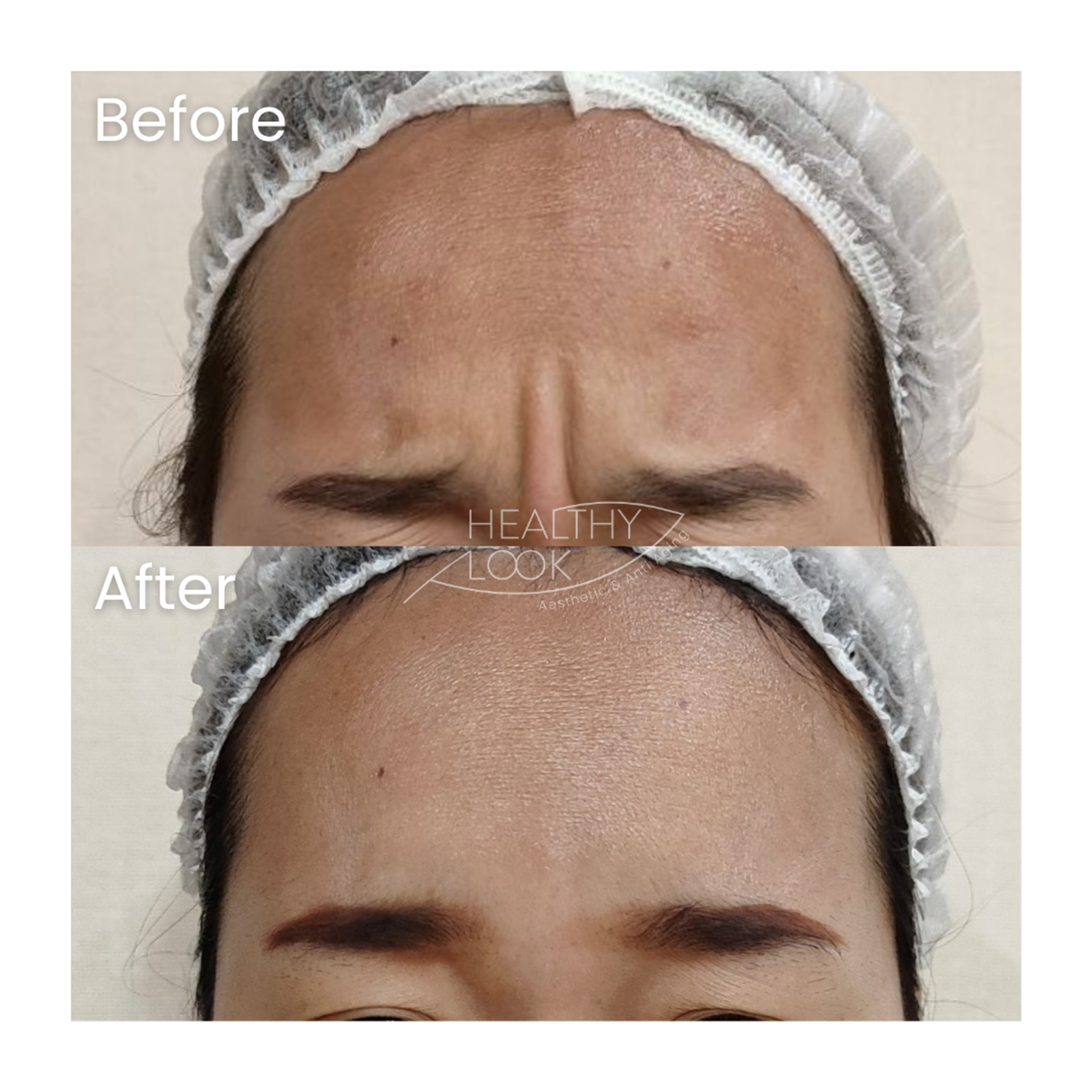 Before and after result 18 for Botox treatment at Healthy Look Aesthetic