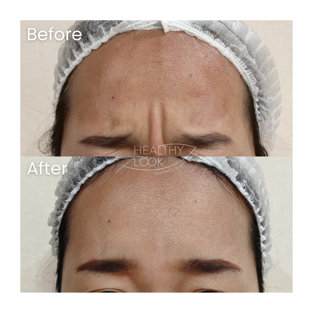 Before and after result 18 for Botox treatment at Healthy Look Aesthetic