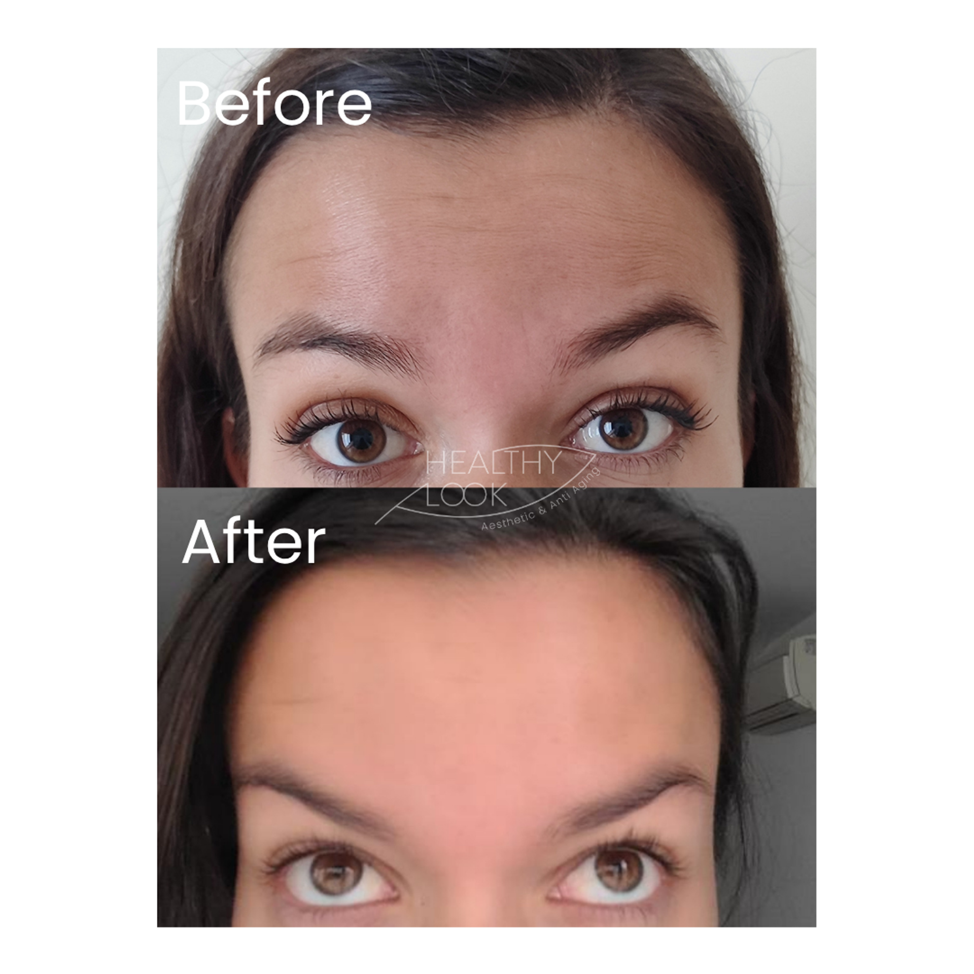 Botox before and after result
