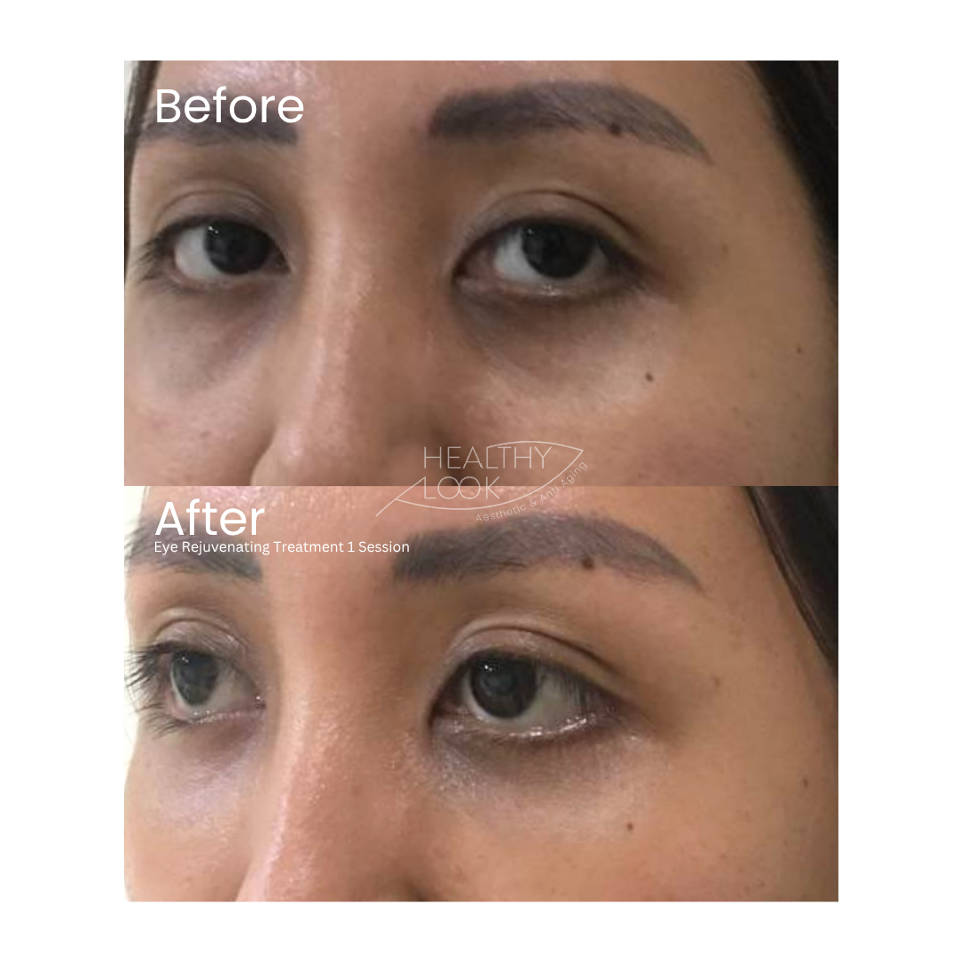 Before and after result 4 for Skin Treatment treatment at Healthy Look Aesthetic