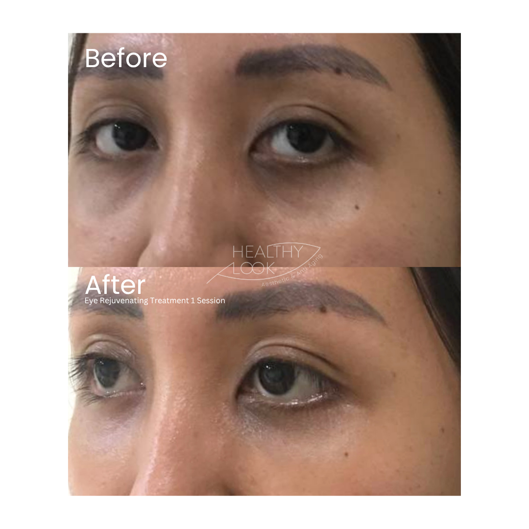 Before and after result 4 for Skin Treatment treatment at Healthy Look Aesthetic