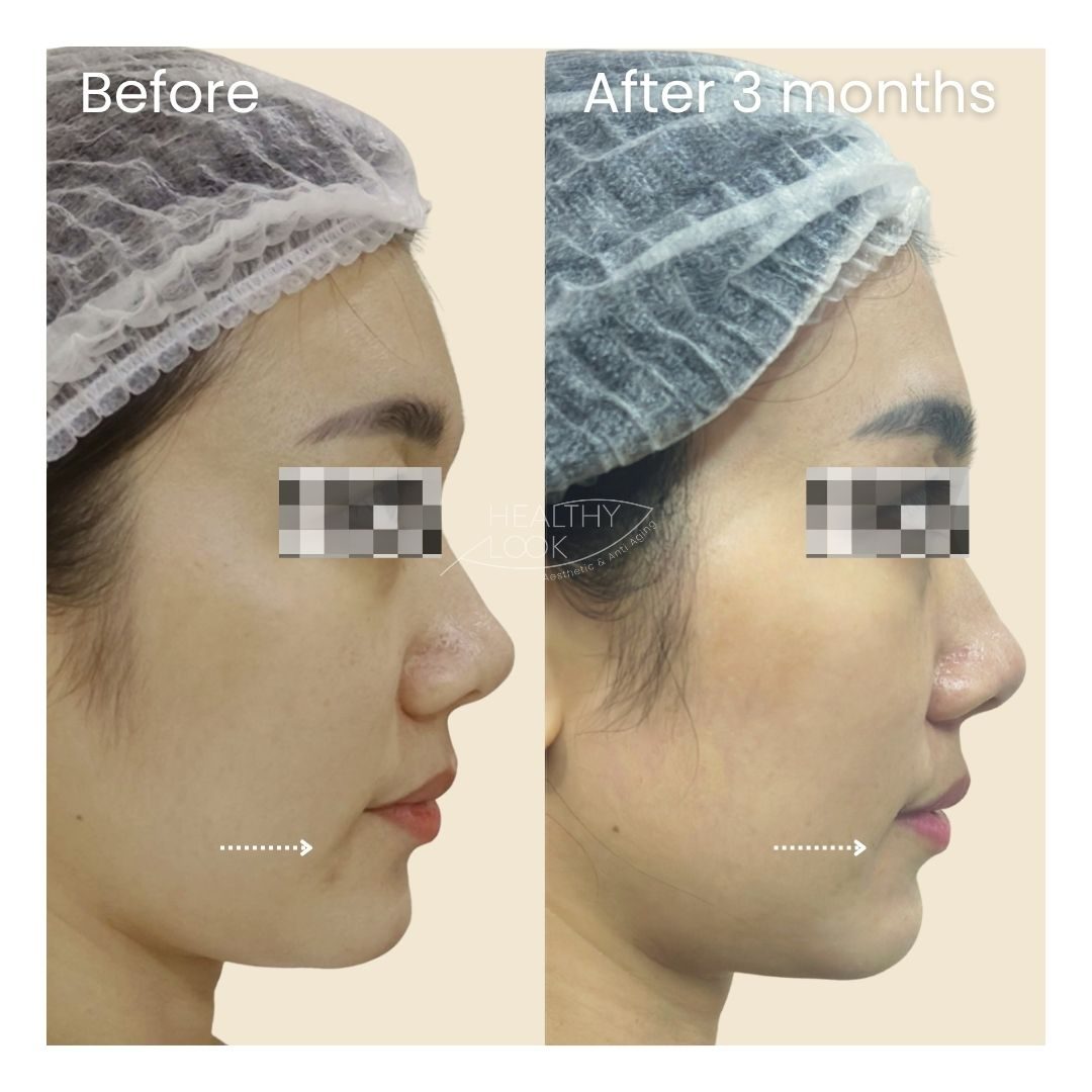Before and after XERF Treatment at Healthy Look Aesthetic, Ubud