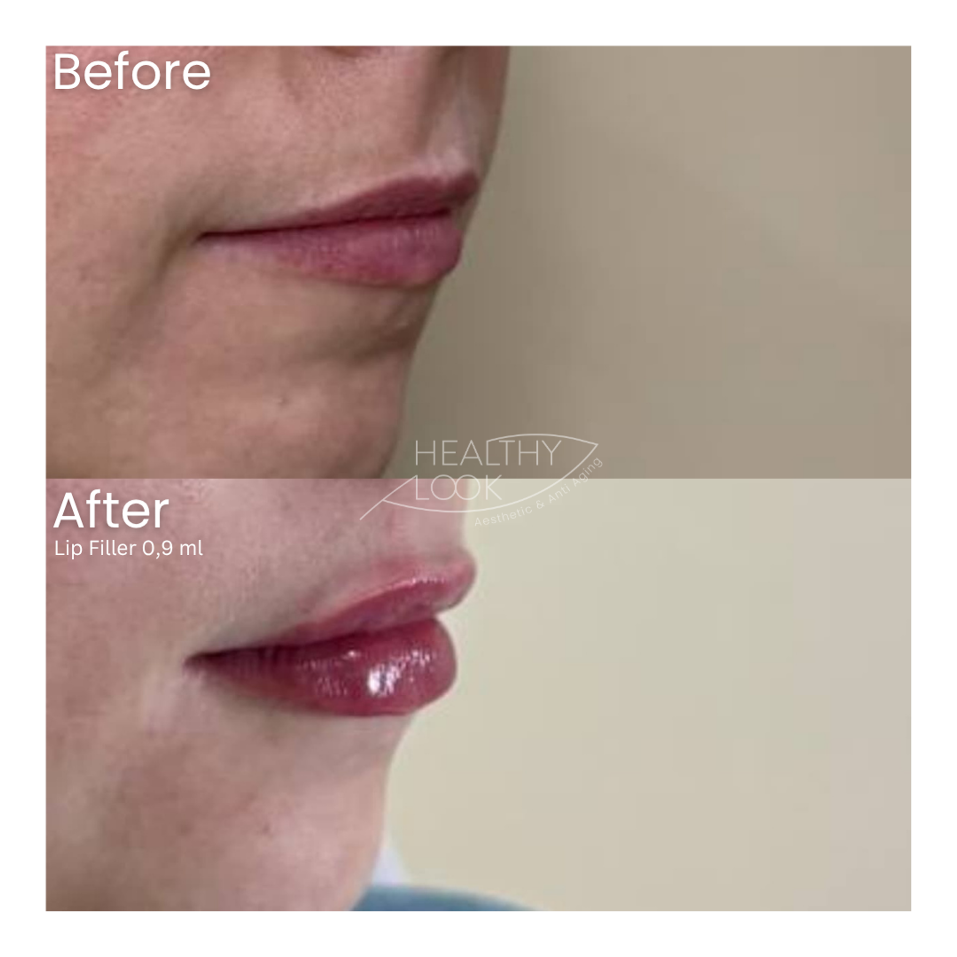 Before and after result 32 for Lip Filler treatment at Healthy Look Aesthetic