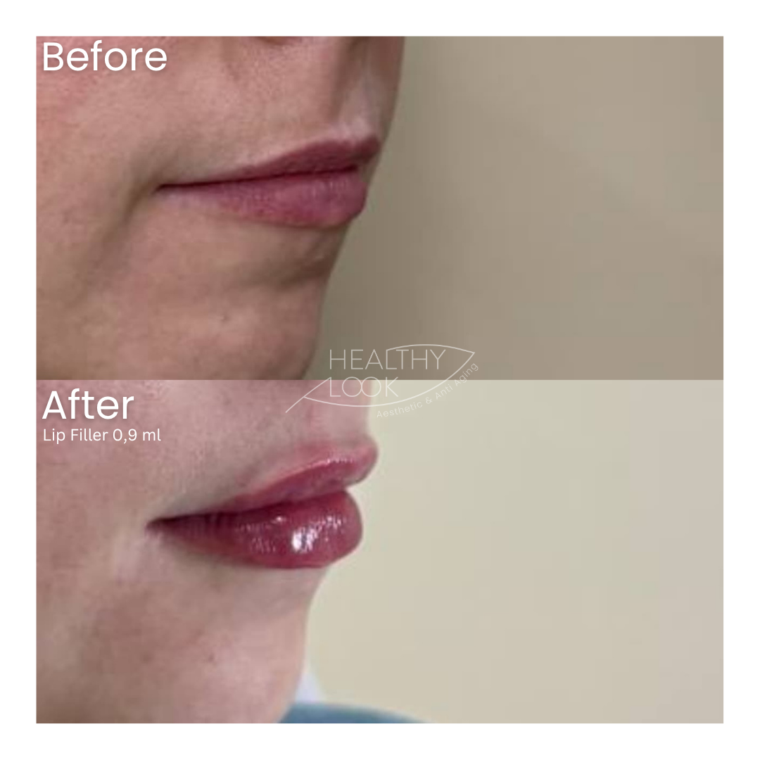 Before and after result 32 for Lip Filler treatment at Healthy Look Aesthetic